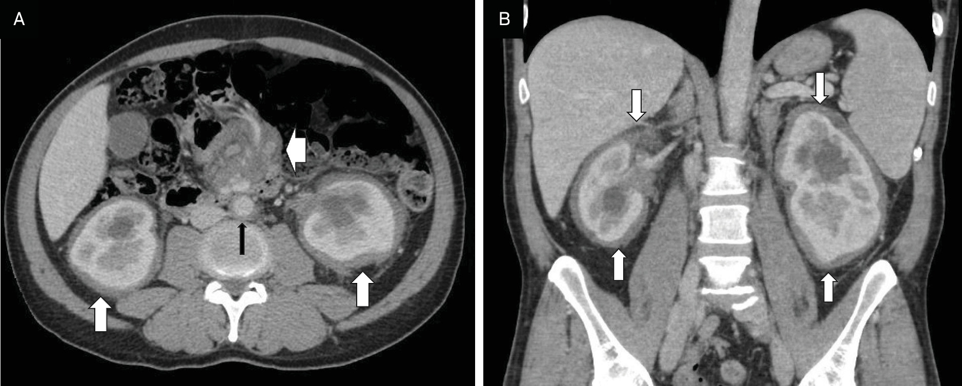 Abdominal CT features of Erdheim-Chester disease. (A, B) Axial and coronal sections of contrast-enhanced CT demonstrating a 6-8-mm-thick rim of infiltrated perinephric fat around both kidneys (arrows). Delayed nephrogram and hydronephrosis are present. An ill-defined 5 cm mesenteric mass encases the visceral vessels (arrowhead), and a circumferential periaortic infiltration is present (black arrow).