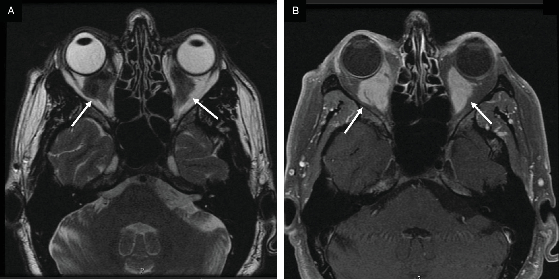 Contrast-enhanced MRI of the orbits. (A) Axial T2 sequence demonstrating hypointense bilateral retrobulbar masses (arrows). (B) Axial T1 with fat suppression revealing hyperintense masses (arrows) measuring about 16 × 22 mm and causing moderate exophthalmos.