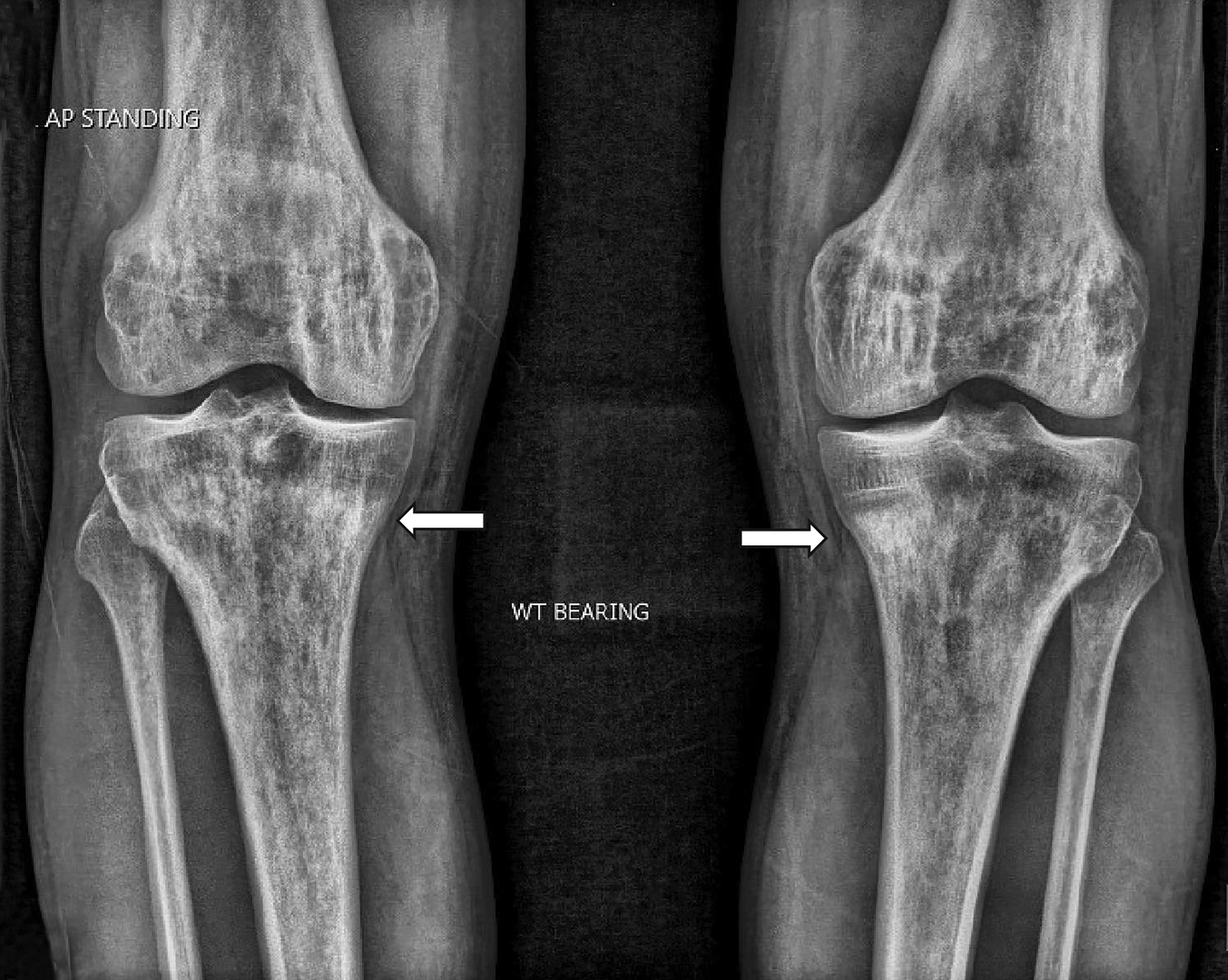Anteroposterior radiographs of both knees demonstrating bilateral osteosclerosis in the metaphyseal regions of proximal tibias (arrows) and the femoral condyles. Multiple osteolytic foci are also visible.