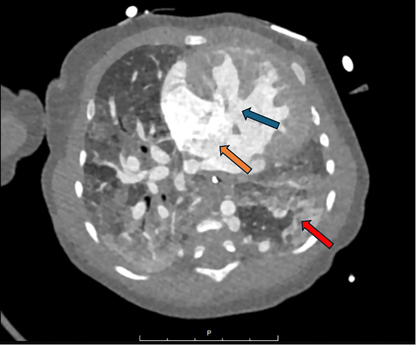 Contrast-enhanced axial CT maximum intensity projection image of the chest demonstrating severely hypoplastic left lung (red arrow) with a large ventricular septal defect (blue arrow) and atrial septal defect (orange arrow). The pulmonary findings are thought to result from atelectasis in the lung bases, right middle lobe, and right upper lobe, with some right upper lobe air trapping noted.