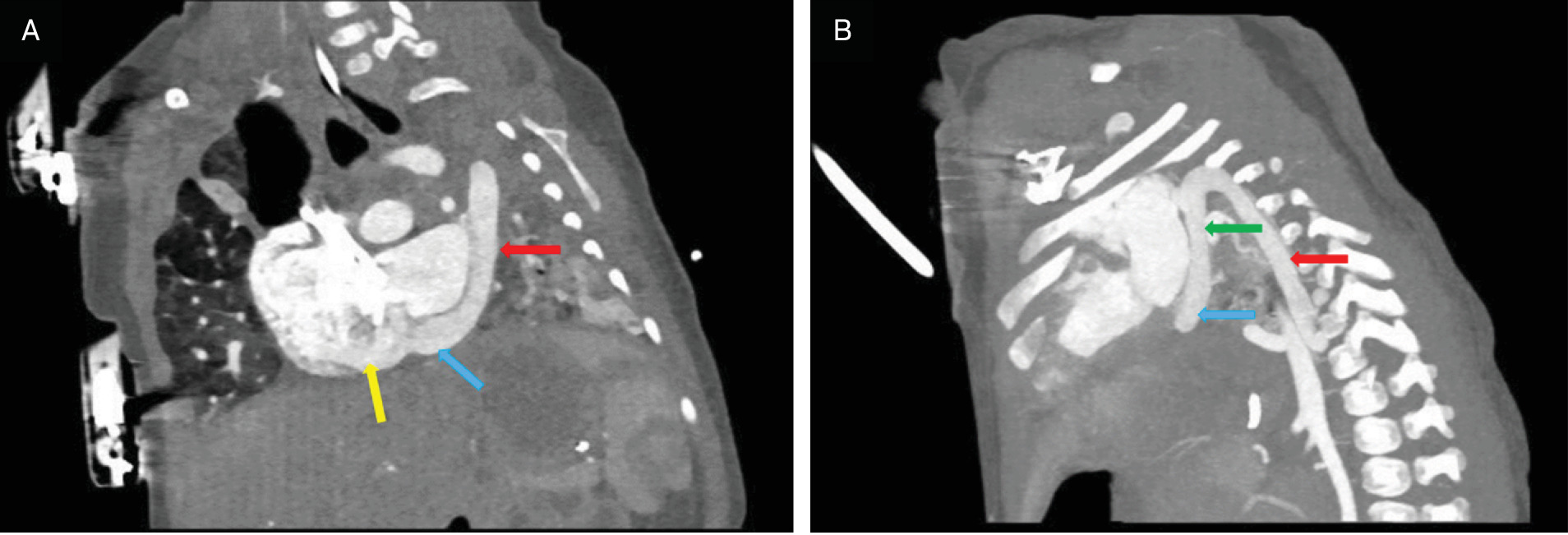 (A) Contrast-enhanced oblique sagittal CT maximum intensity projection (MIP) image of the chest demonstrating a left-sided superior vena cava (SVC, red arrow) draining into an enlarged coronary sinus (blue arrow), which empties into the dilated right atrium (yellow arrow). Also shown is a severely hypoplastic left lung. (B) Contrast-enhanced sagittal chest CT MIP image demonstrating anomalous pulmonary veins draining into the hemiazygos vein (red arrow), which drains into the left-sided SVC (green arrow) and eventually empties into the coronary sinus (blue arrow).