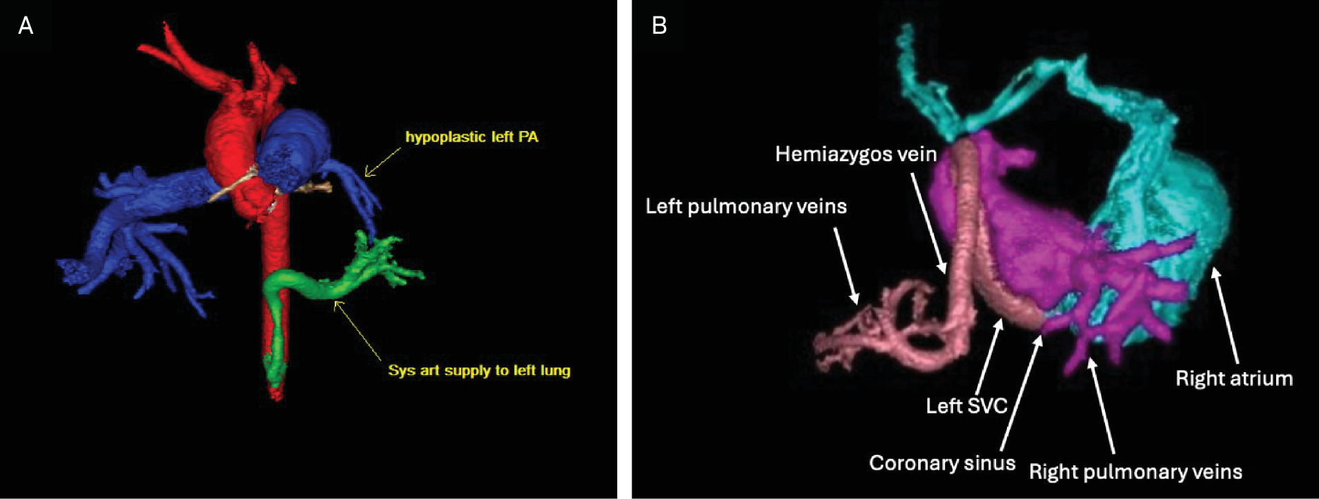 (A) Three-dimensional reconstruction of the patient’s left-sided scimitar syndrome, with the diminutive left pulmonary artery shown and the anomalous systemic arterial supply to the left lung arising from the proximal abdominal aorta (red). (B) Three-dimensional reconstruction demonstrating the anomalous drainage of the left pulmonary veins into the hemiazygos vein, the left-sided superior vena cava, the coronary sinus, and ultimately into the dilated right atrium. The normal right-sided pulmonary veins (pink) are included for comparison.