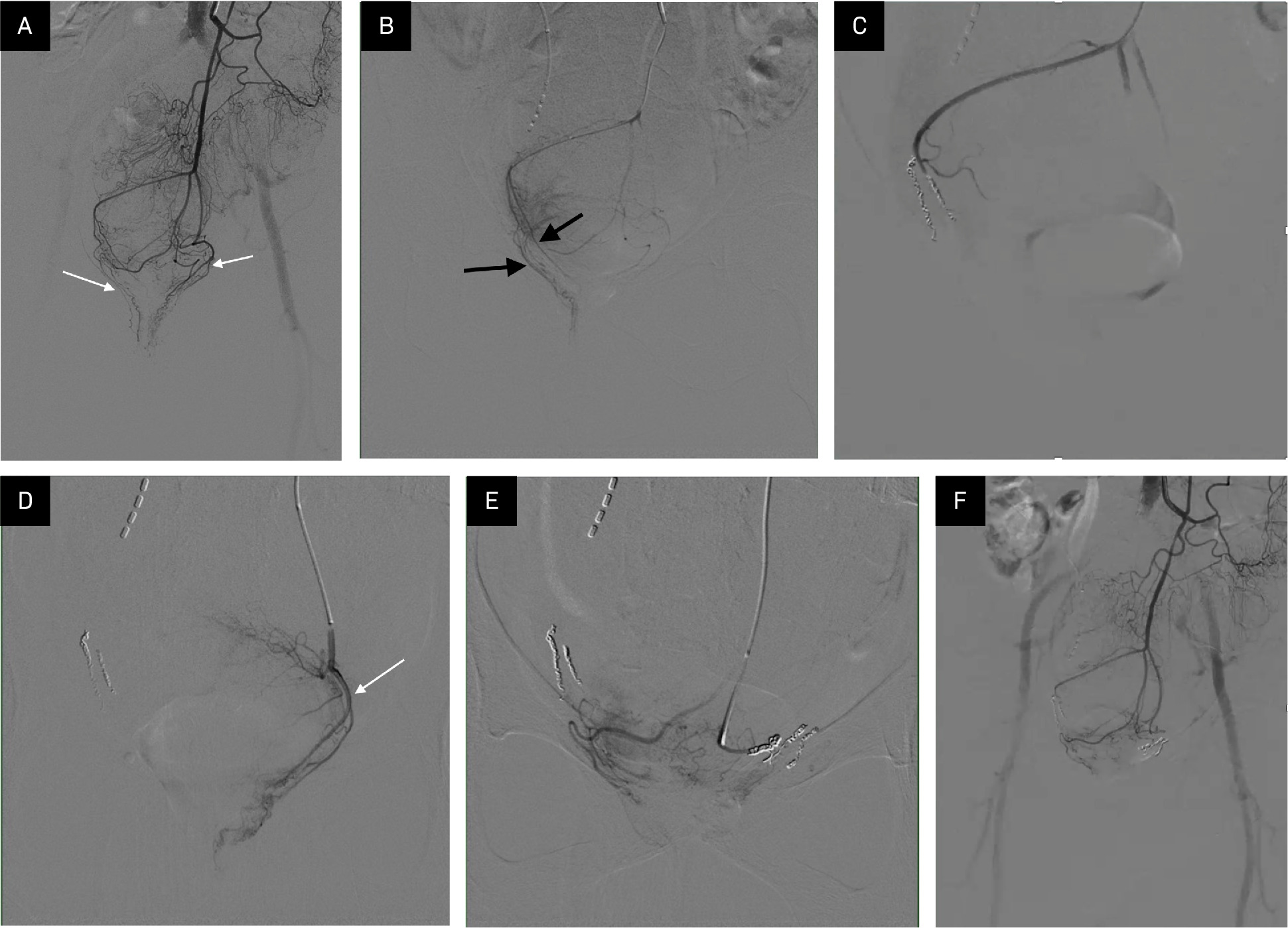 (A) Inferior mesenteric arteriogram demonstrates dominant, hypertrophied superior rectal arteries supplying the corpus cavernosum recti below the pubic symphysis (white arrows). (B) Selective arteriogram of right-sided superior rectal arteries reveals blush of the corpus cavernosum recti (black arrows). (C) Two dominant terminal branches embolized using a combination of microspheres and coils. (D) Selective arteriogram of a dominant left superior rectal artery (SRA) branch reveals opacification of blush within the corpus cavernosum recti (thin white arrow). (E) This branch was also embolized using a combination of microspheres and coils. (F) Final arteriogram from the inferior mesenteric artery demonstrates no opacification of the corpus cavernosum recti following embolization of the dominant terminal branches of the SRAs.