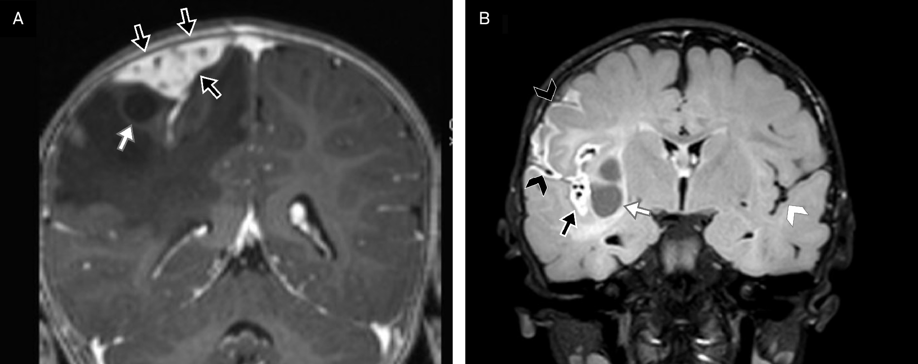 Desmoplastic infantile gangliocytoma imaging features. (A) T1 postcontrast image in a 9-month-old girl demonstrates a cortical-based tumor in the frontoparietal vertex. (B) T2 FLAIR postcontrast imaging in a 1-year-old boy demonstrates a cortical-based tumor in the sylvian fissure. These tumors are mixed cystic-solid masses with cystic components (white arrows) deep to avidly enhancing solid components (black arrows). Patient B demonstrates the most common metastatic site, with leptomeningeal enhancement (arrowheads) and experienced multiple subsequent recurrences requiring multiple resections. Patient B’s solid component (black arrow) also encases the insular M2 middle cerebral artery and adjacent deep veins, which is easiest to appreciate when comparing to the flow voids on the contralateral side (white arrowhead).