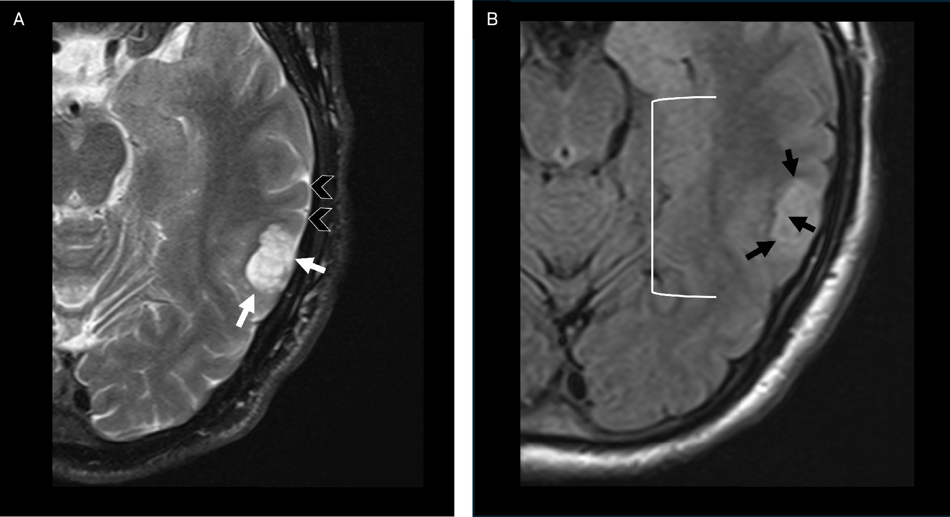 Dysembryoplastic neuroepithelial tumor. Axial T2 (A) demonstrates a T2-hyperintense multicystic lesion in the left temporal lobe (white arrows). On axial T2 FLAIR (B), the lesion demonstrates a hyperintense ring (black arrows), suggestive of the “FLAIR rim” sign. This tumor does not demonstrate features associated with higher grade tumors and worse outcomes. Specifically, there are no satellite lesions, which would most commonly be found along the medial aspect of the tumor (white bracket), and the adjacent cortex has no focal dysplasia.