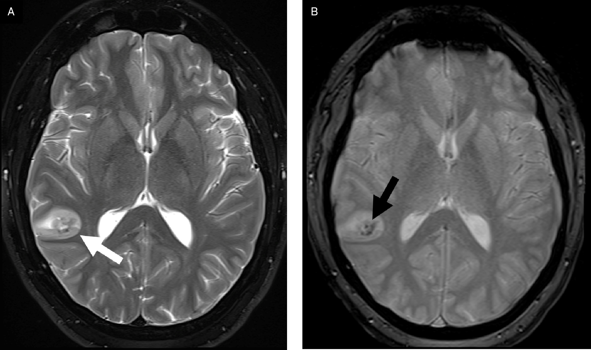 Polymorphous low-grade neuroepithelial tumor of the young. Axial T2 (A) MRI demonstrates a T2-hyperintense cortically based lesion in the right temporal lobe (white arrow) with central heterogeneous signal. This central signal demonstrates susceptibility artifact (black arrow) on susceptibility-weighted imaging (B), consistent with calcification.