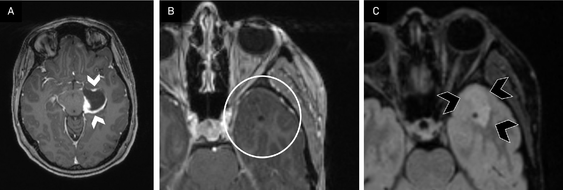 Variable imaging presentation of gangliogliomas. Ganglioglioma appearance can vary on imaging, owing to factors such as composition (cystic vs mixed cystic solid), borders (well-circumscribed vs infiltrative), and postcontrast enhancement. Two patients with pathology-proven gangliogliomas demonstrate this spectrum. Imaging of patient (A) shows a well-circumscribed, primarily cystic, tumor in the classic temporal lobe location with peripheral enhancement (white arrowheads) on T1 postcontrast imaging. Imaging of the second patient (B, C) demonstrates an infiltrative, mostly solid tumor with no enhancement (B, white oval), which is better visualized on T2 FLAIR (C, black arrowheads). Neither tumor had calcifications, which can occur in up to half of gangliogliomas. Given this variability, ganglioglioma is important to keep on the differential for cortical-based epilepsy-associated neoplasms.