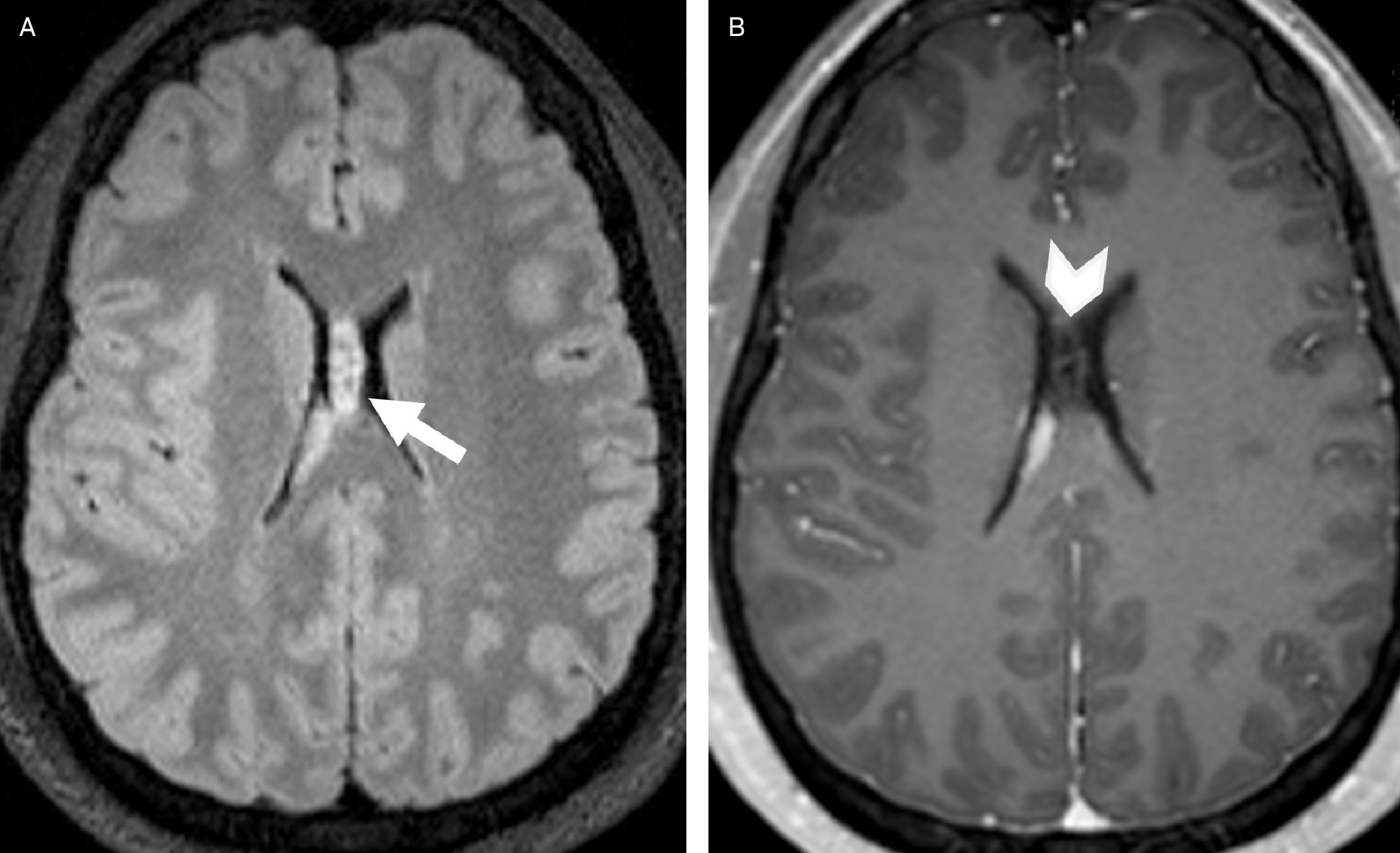 Myxoid glioneuronal tumor (formerly dysembryoplastic neuroepithelial tumor [DNET] of the septum pellucidum). Axial T2 FLAIR imaging (A) demonstrates a mass in the septum pellucidum (arrow) with imaging features similar to DNET: well-circumscribed with multiple hyperintense internal cystic structures. The mass is nonenhancing on axial postcontrast T1 image (B, arrowhead), consistent with the variable enhancement patterns of DNET. At biopsy, the mass was confirmed to contain histological characteristics of DNET of the septum pellucidum, which subsequently was classified as myxoid glioneuronal tumor. Genetic testing for PDGFRA was not performed for this patient owing to lack of testing availability but would be considered the gold standard for myxoid glioneuronal tumor diagnosis.