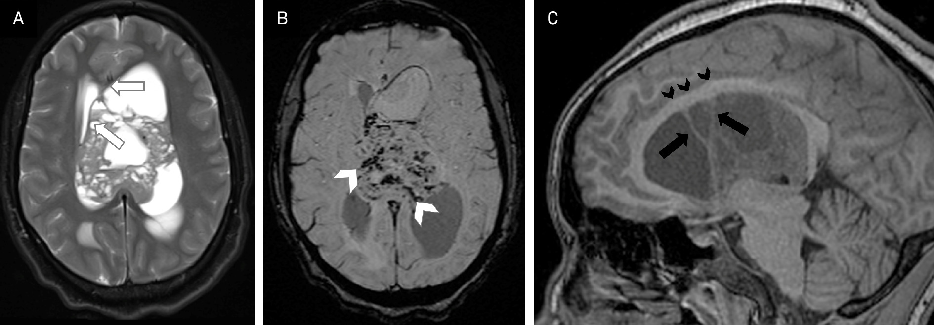 Central neurocytoma. Axial T2 (A) and susceptibility-weighted imaging (B) images show a mixed cystic solid mass with abutment and bowing of the septum pellucidum (white arrows). Susceptibility artifact (white arrowheads) from calcification and vascularity helps differentiate it from myxoid glioneuronal tumor. The “scalloping sign” is seen on sagittal T1 precontrast imaging (C) with peripheral cysts creating radial lines from their walls (black arrows) and a wavy appearance of the ventricular wall (black arrowheads).