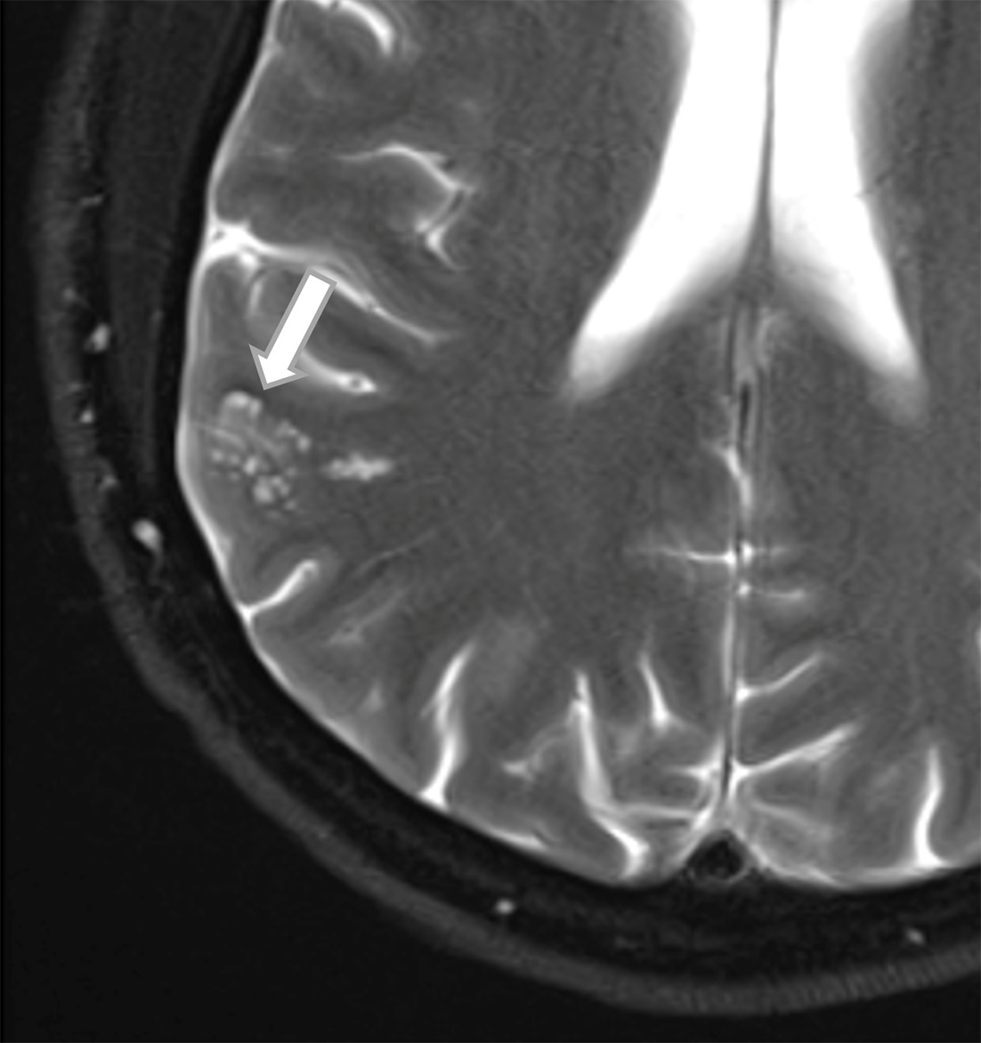 Multinodular and vacuolating neuronal tumor (MVNT). Axial T2 fat-saturated image demonstrates a cluster of juxtacortical hyperintense cysts (arrow) in the right parietal lobe, classic findings for MVNT. This lesion will typically not demonstrate enhancement on postcontrast images nor will it have diffusion restriction.