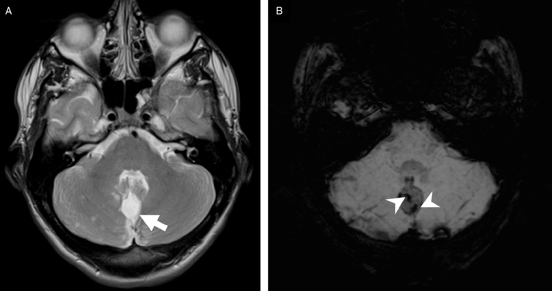 Rosette-forming glioneuronal tumor (RGNT). Axial T2 imaging (A) demonstrates a small (<3.0 cm) hyperintense lesion in the posterior fossa abutting the 4th ventricle (arrow). Susceptibility-weighted imaging (B) has susceptibility artifact (arrowheads) consistent with microhemorrhages. Susceptibility artifact from calcification would be exceedingly rare in RGNT and more consistent with a glioneuronal tumor or pilocytic astrocytoma.