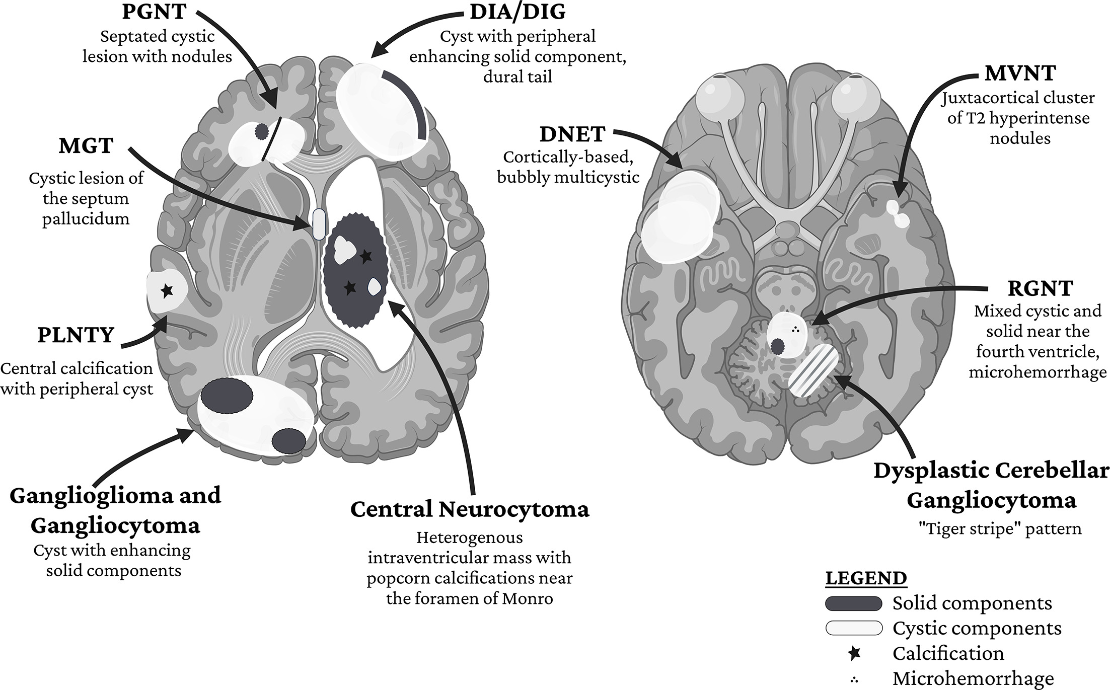 Summary of classic glioneuronal tumor imaging findings.