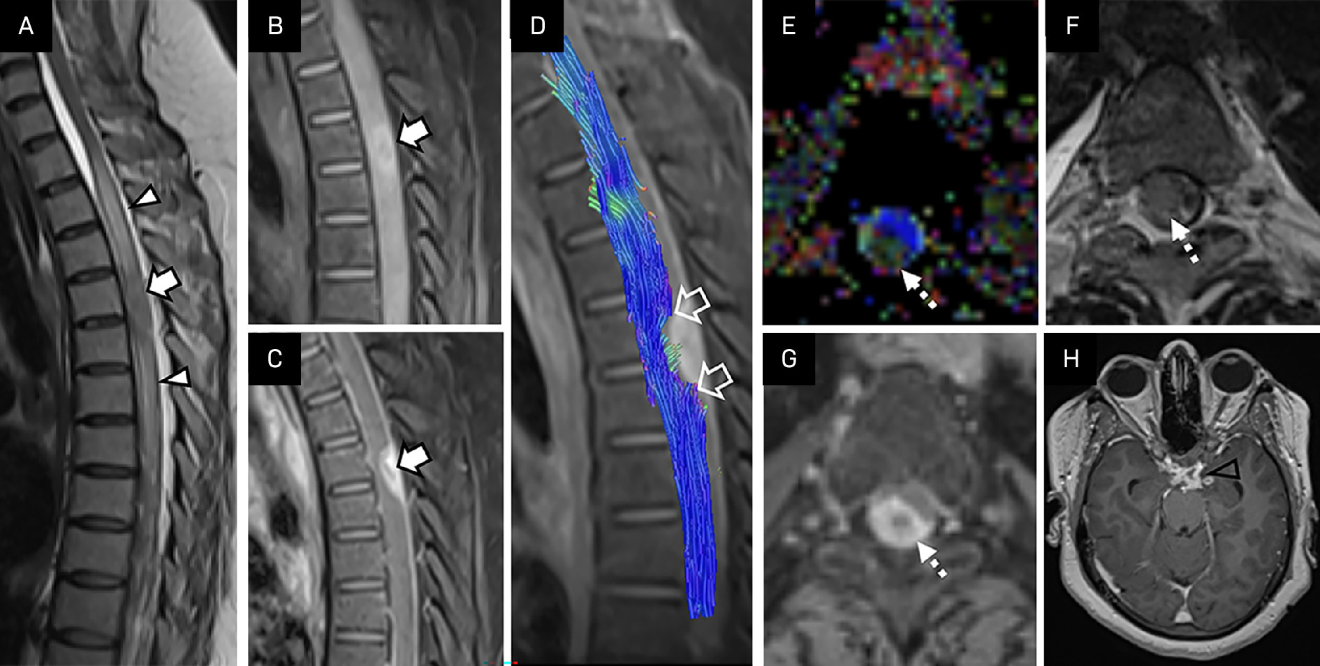 A 44-year-old woman with complete paraplegia with urinary retention (Japanese Orthopaedic Association score 5) and seizures. T2W-sagittal (A), pre- and postcontrast T1W fat-saturated sagittal (B, C), tractography (D), colored fractional anisotropy (FA) map (E) with corresponding T2W-axial (F) and postcontrast T1W-axial (G) images at the same level show a well-defined enhancing T2-hypointense lesion within the cord (white solid arrows in A-C), measuring 20 × 7 mm at D4-D5 vertebral level, with surrounding myelitis from D1-D7 level (white arrowheads in A) displacing the cord anteriorly and left laterally, causing disruption of fibers (hollow arrows in D) without any significant displacement, typical of the type II tractography pattern. There is an alteration of signal on colored FA map at the level of the lesion (dashed arrows in E-G). Postcontrast T1W section of brain (H) shows enhancing exudates in the basal CSF cisterns with few ring-enhancing lesions in the left temporal lobe (hollow arrowhead in H), consistent with the diagnosis of craniospinal tuberculosis.