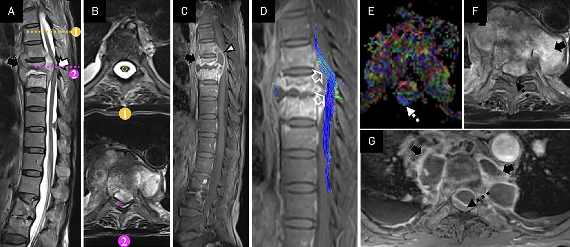 A 60-year-old man with paraplegia without bowel-bladder involvement (Japanese Orthopaedic Association score 10). T2W-sagittal (A), region of interest plotting on T2W-axial sections “At” and “Above” the level of cord compromise (B), postcontrast T1W-sagittal (C), tractography (D), colored fractional anisotropy (FA) map (E) with corresponding T2W-axial (F) and postcontrast T1W-axial (G) images at the same level show subligamentous T2-hyperintense peripherally enhancing prevertebral abscess (black solid arrows in A, C, F, G) at D5-D8 level and anterior epidural abscess (white arrowhead in C), measuring ~13 mm in thickness at D6-D7 vertebral level, resulting in T2-hyperintense signal within the cord (white solid arrow in A) with posterolateral displacement of cord (black dashed arrows in F, G) and disruption of fibers (hollow arrows in D), typical of type IV tractography pattern. There is an alteration of signal within the spinal cord on colored FA map at the level of the lesion (white dashed arrow in E).