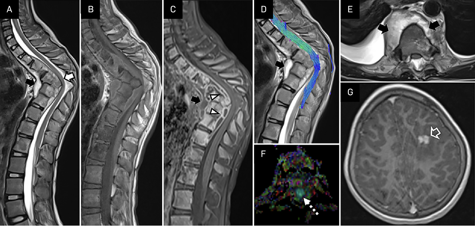 A 20-year-old woman with complete paraplegia and urinary retention (Japanese Orthopaedic Association score 4) and seizures. T2W-sagittal (A), precontrast T1W-sagittal (B), postcontrast T1W-fat saturated sagittal (C), tractography (D), colored fractional anisotropy (FA) map (F) with corresponding T2W-axial (E) image at the same level show destruction and anterior wedge collapse of D4, D5, and D6 vertebrae with subligamentous T2-hyperintense peripherally enhancing prevertebral abscess (black solid arrows in A, C, D, E) and anterior epidural abscess (white arrowheads in C), measuring ~5.8 mm in thickness at D1 to L1 vertebral levels causing gibbus deformity and posterior displacement of cord without any disruption of fibers, typical of the type III tractography pattern; however, no T2-hyperintense signals were noted within the cord. There is signal alteration of the cord on colored FA map at the level of the lesion (dashed arrow in F). Postcontrast T1W image of the brain (G) shows few ring and nodular enhancing lesions in the left frontal lobe (hollow arrow in G), suggesting disseminated CNS tuberculosis.