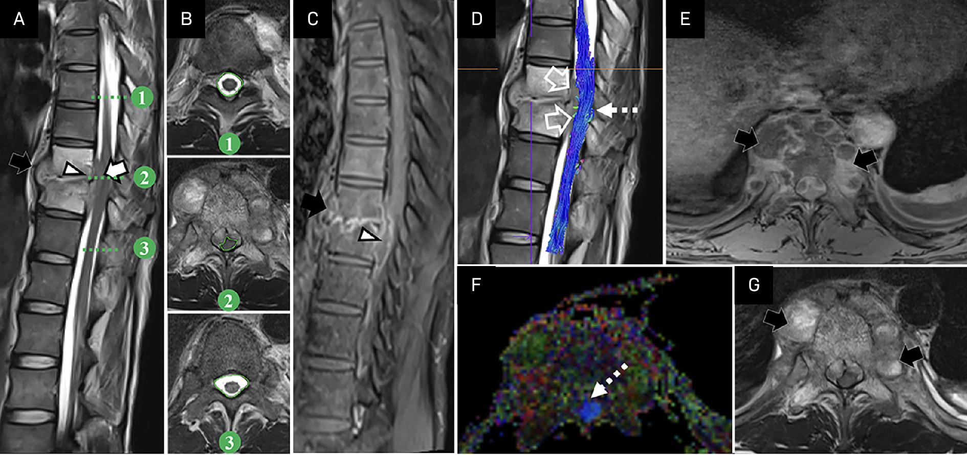 A 50-year-old man with paraplegia and severe bowel-bladder dysfunction (Japanese Orthopaedic Association score 9). T2W-sagittal (A), T2W-axial images taken above, at, and below the site of cord compromise for estimation of spinal canal encroachment (B), postcontrast T1W-sagittal (C), tractography (D), colored fractional anisotropy (FA) map (F) with corresponding postcontrast T1W (E) and T2W-axial (G) images at the same level show typical paradiscal pattern of spinal TB with subligamentous T2-hyperintense peripherally enhancing prevertebral abscess (black solid arrows in A, C, E, G) and anterior epidural abscess (white arrowheads in A, C) measuring ~8 mm in thickness at D8-D11 vertebral levels with T2-hyperintensity within the cord at D9-D10 level causing posterior displacement of cord and disruption of fibers (hollow arrows in D), typical of the type IV tractography pattern. There is a mild alteration of signal on tractography and colored FA map at the level of the lesion (dashed arrows in D, F).