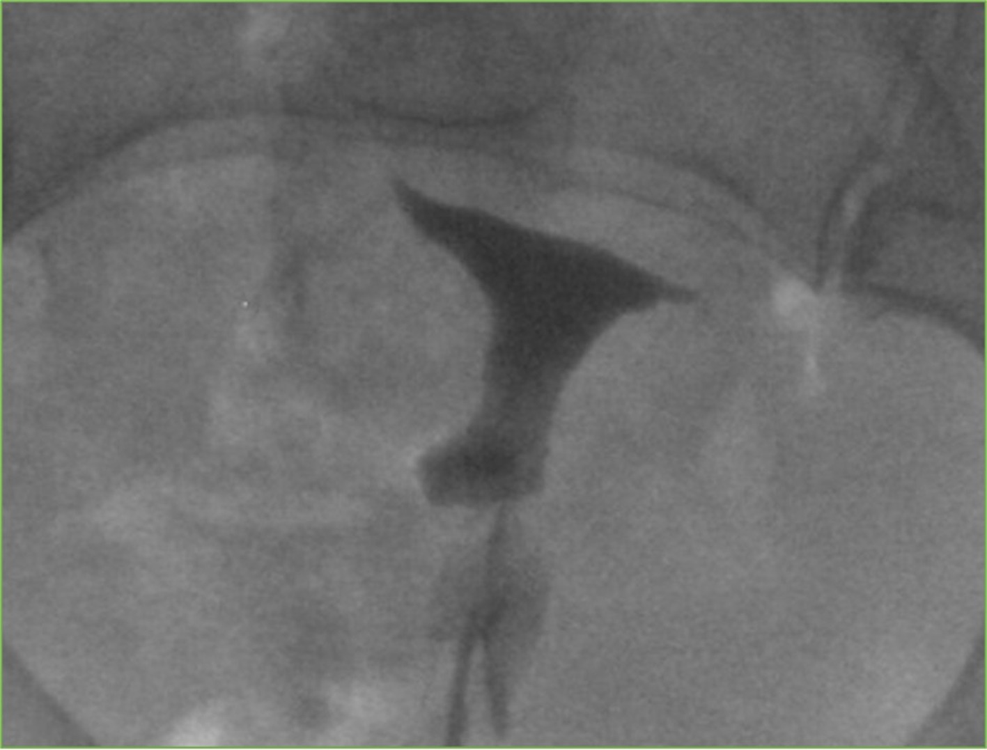 Initial hysterosalpingogram. Initial hysterosalpingogram with iodinated contrast demonstrates absence of opacification of the proximal aspect of the bilateral fallopian tubes, compatible with proximal fallopian tube obstruction.