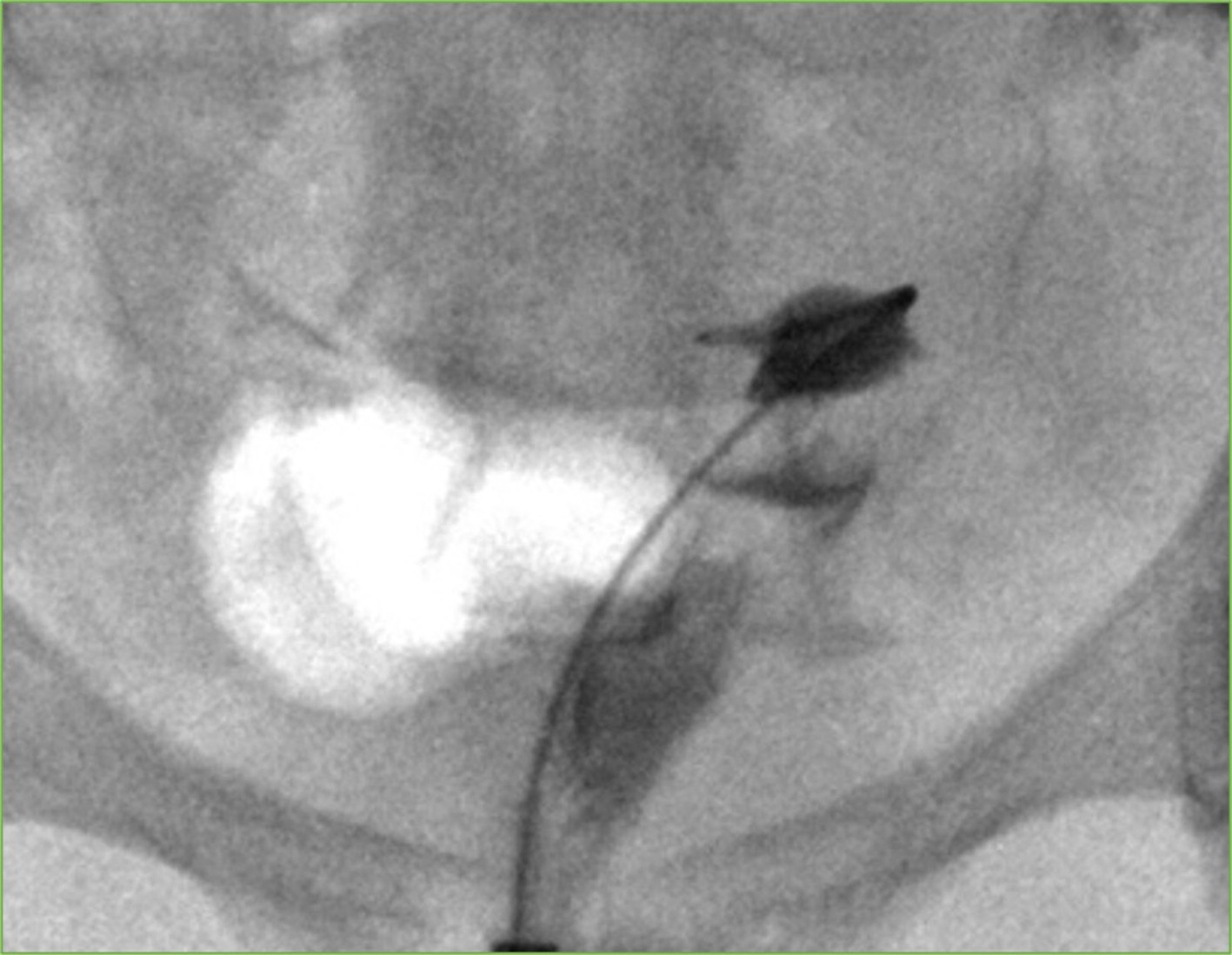 Selective catheterization. A 5-French angled catheter and 0.035-inch glidewire are used to selectively catheterize the right fallopian tube.