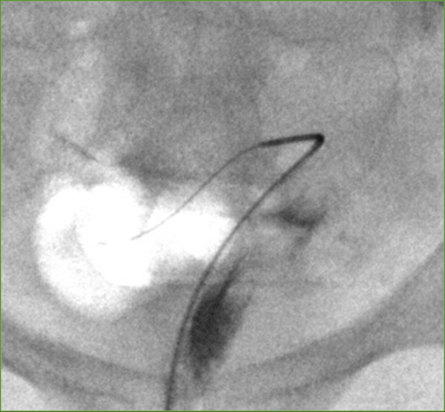 Wire recanalization. The glide wire is advanced to the distal aspect of the right fallopian tube, clearing the proximal fallopian tube of debris.
