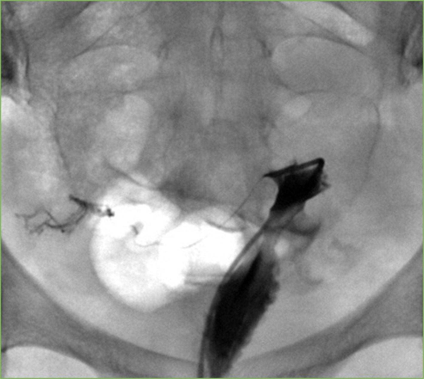 Selective salpingography. Selective salpingography performed via the 5-French catheter from the ostium of the right fallopian tube reveals opacification of the entire length of the fallopian tube with free spillage of contrast into the peritoneum following successful fallopian tube recanalization.