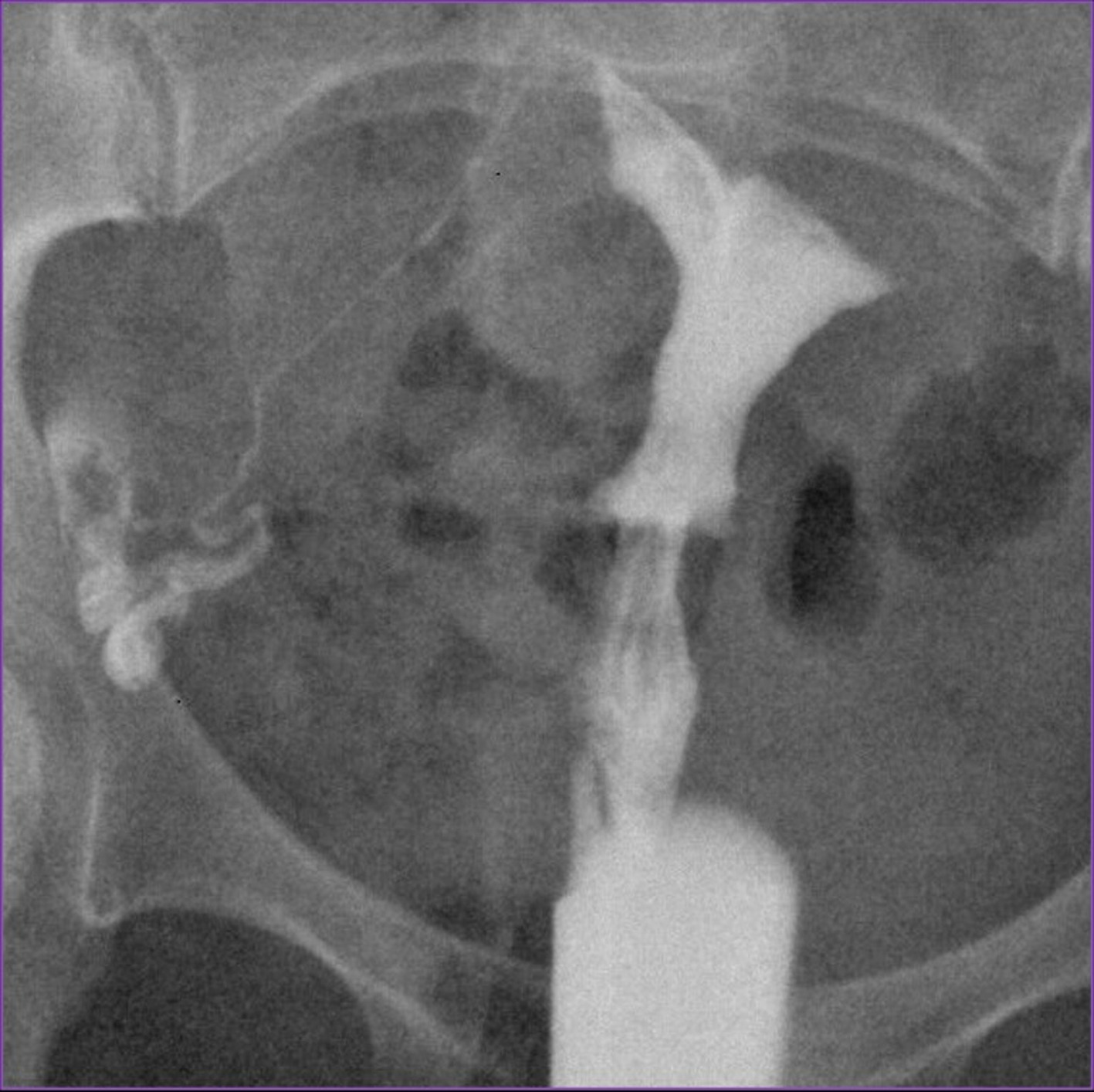 Final salpingogram. Final salpingogram again demonstrates complete opacification of the right fallopian tube with free spillage of contrast into the peritoneum following treatment of proximal fallopian tube obstruction with recanalization.