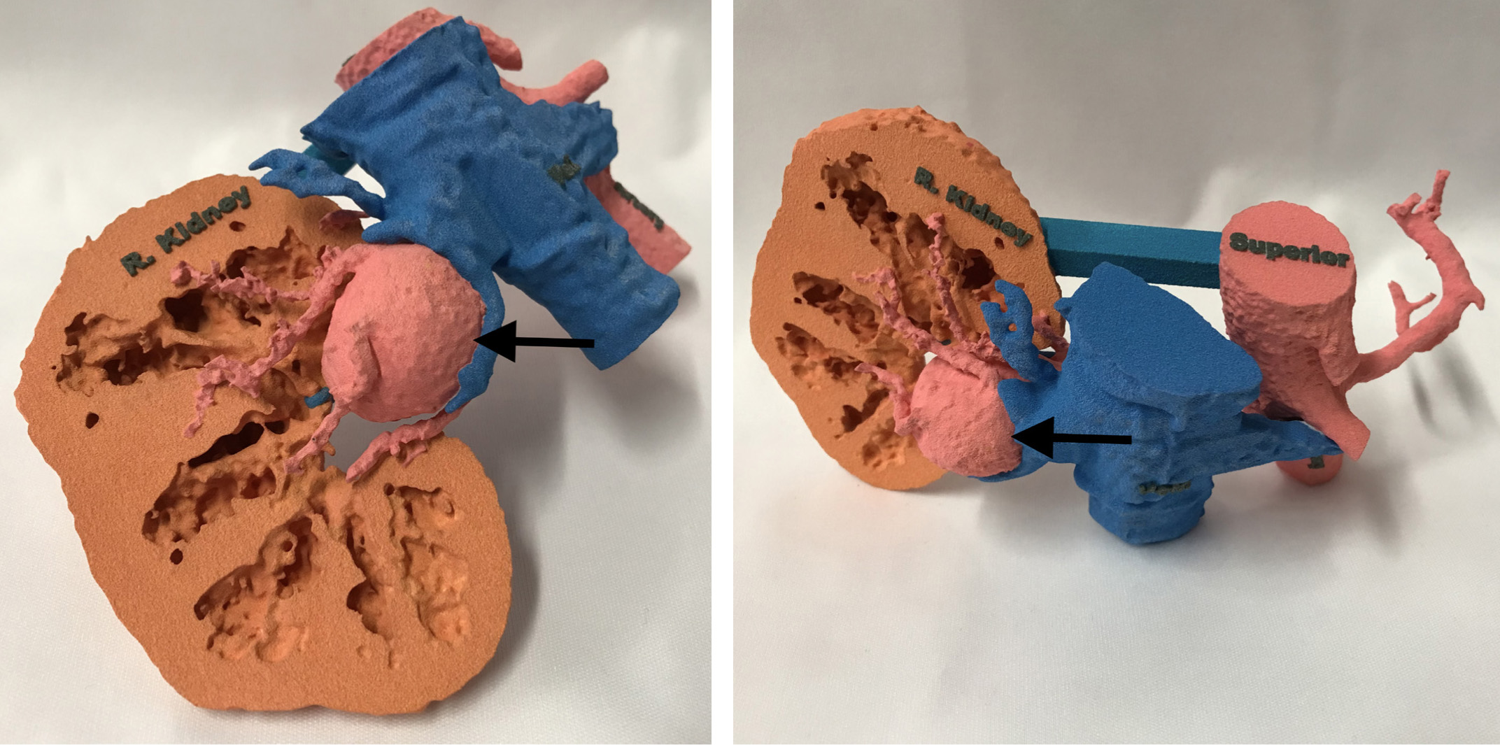 An adult with a 3.2 cm right renal artery aneurysm
