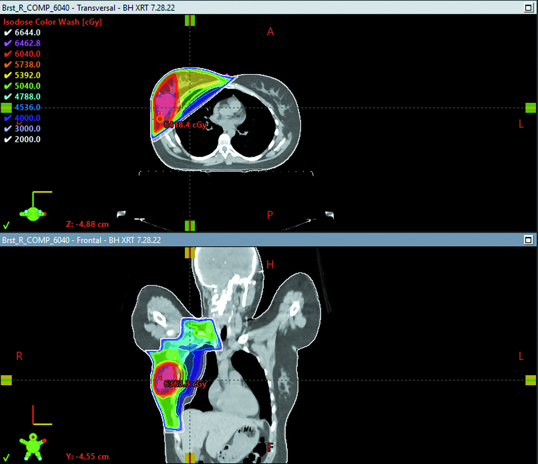 Axial view of the patient’s CT-based radiation treatment plan summary. The right whole breast and regional lymph nodes (axillary, supraclavicular, internal mammary) were treated utilizing a 3D conformal technique. A dose of 5040 cGy was delivered in 28 fractions of 180 cGy each. The dose was delivered using 10 MV photons, prescribed to the planning target volume (PTV). Custom multileaf collimator blocking was used to shield uninvolved tissue. This was followed by a boost to the tumor bed delivered with 10 MV photons, utilizing a 3D conformal technique, prescribed to PTV. A boost dose of 1000 cGy was delivered in 5 fractions of 200 cGy each. Dose color wash is represented in cGy.