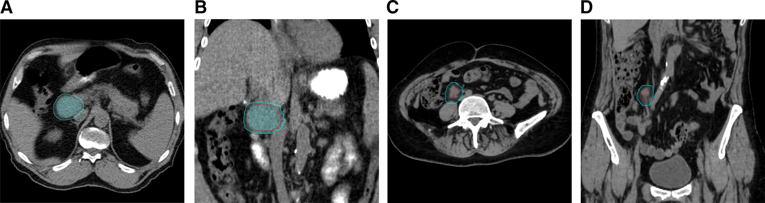 Examples of different tumor location classifications. Case 1: Planning target volume (PTV) proximity to the vertebral column > 1 cm and superior to the renal arteries in axial (A) and coronal views (B). Case 2: PTV proximity to the vertebral column ≤ 1 cm and inferior to the renal arteries in axial (C) and coronal views (D).