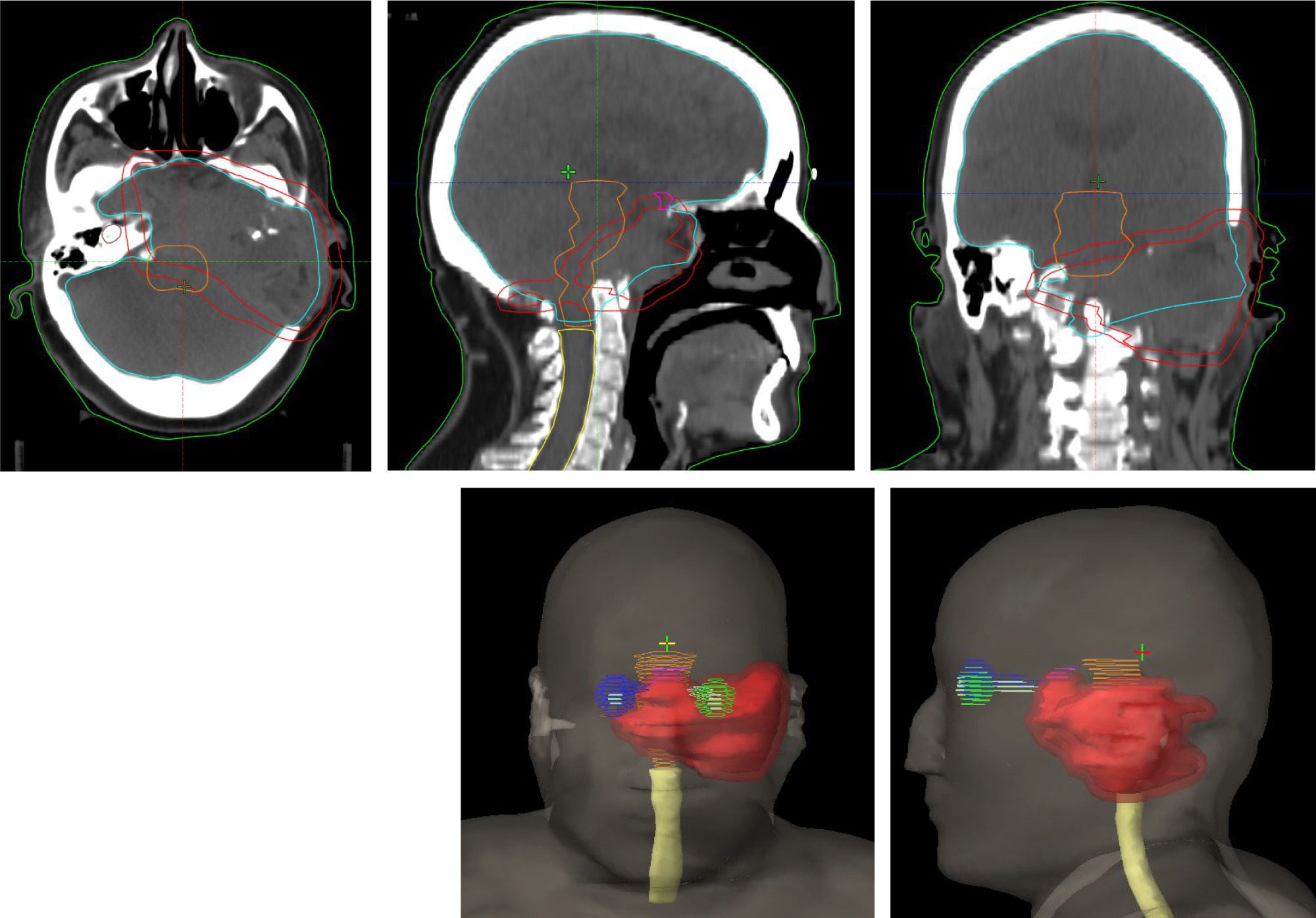 Planning CT images with contours of lesion (red: planning target volume [PTV]) and adjacent normal structures (green: left retina; dark blue: right retina; cyan: brain; orange: brainstem; yellow: spinal cord).