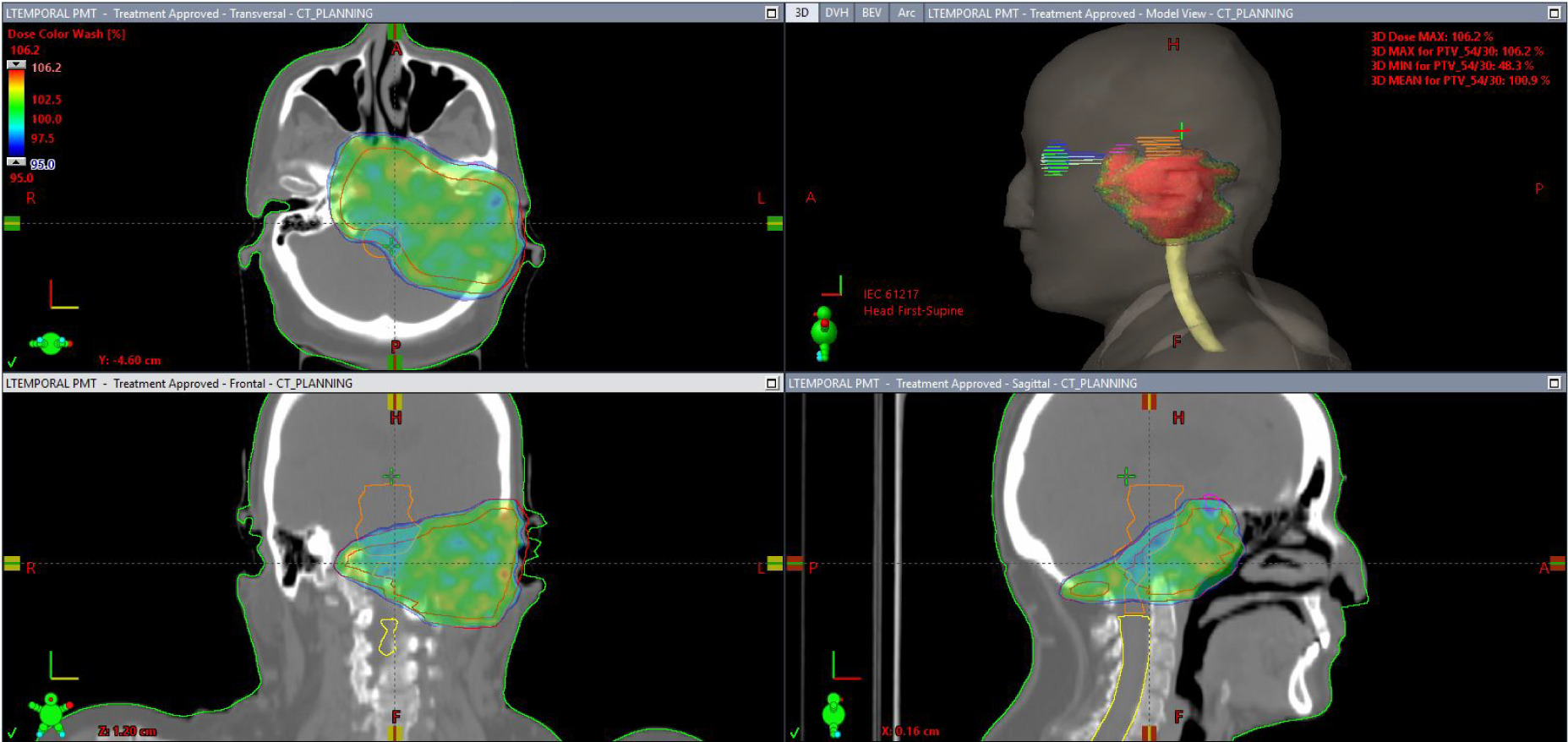 Treatment plan showing radiation dose distribution (green color) in color wash and planning target volume (PTV) (red contour).
