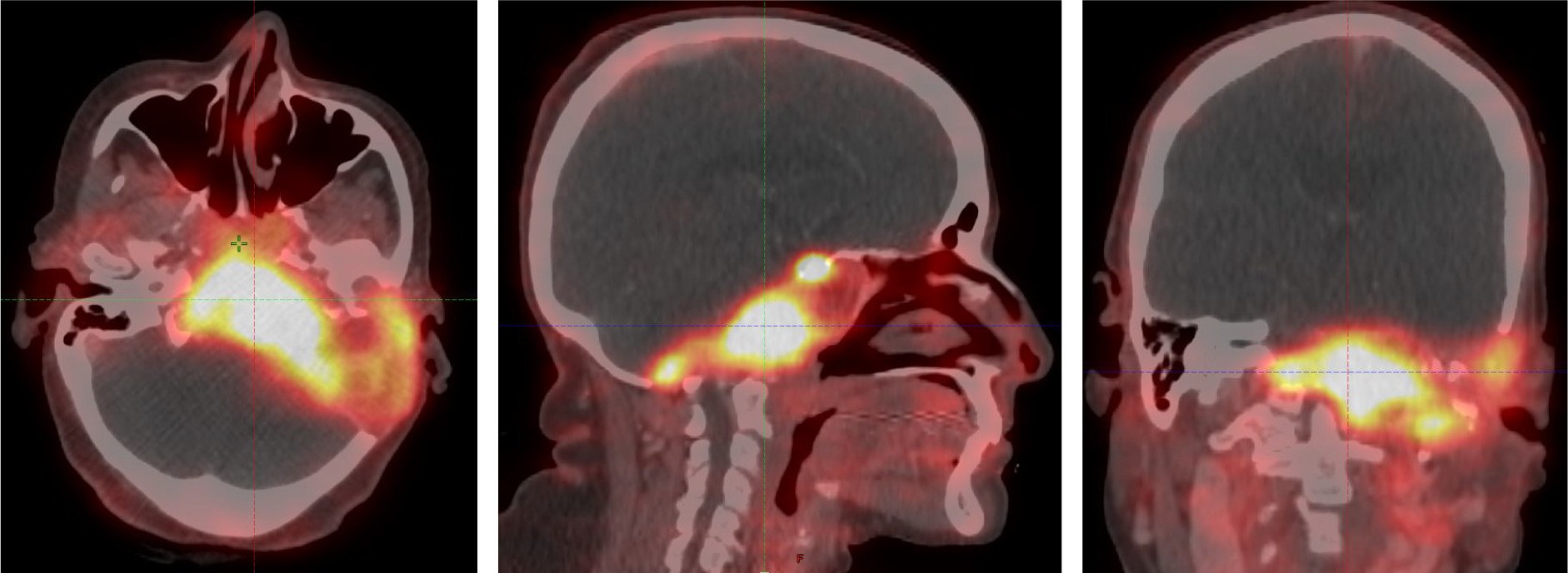 Gallium 68 dotatate PET/CT images showing a tracer avid lytic lesion at the skull base.