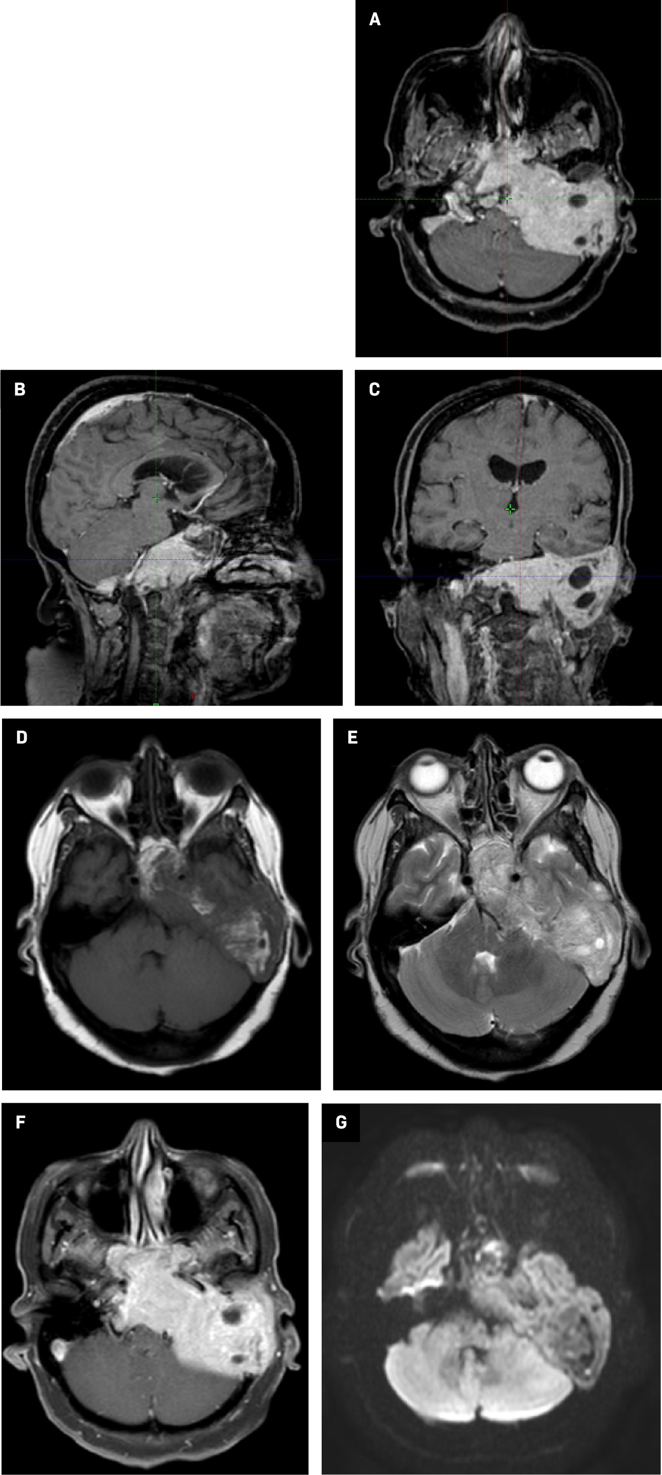 MRIs showing the lesion at the skull base: T1 with contrast (A-C),T1 plain (D), T2 (E), fluid-attenuated inversion recovery (FLAIR) (F), and diffusion-weighted imaging (DWI) (G).
