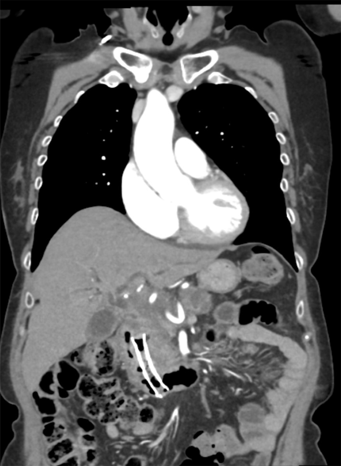 Coronal CT image of the migrated stent into the duodenum.