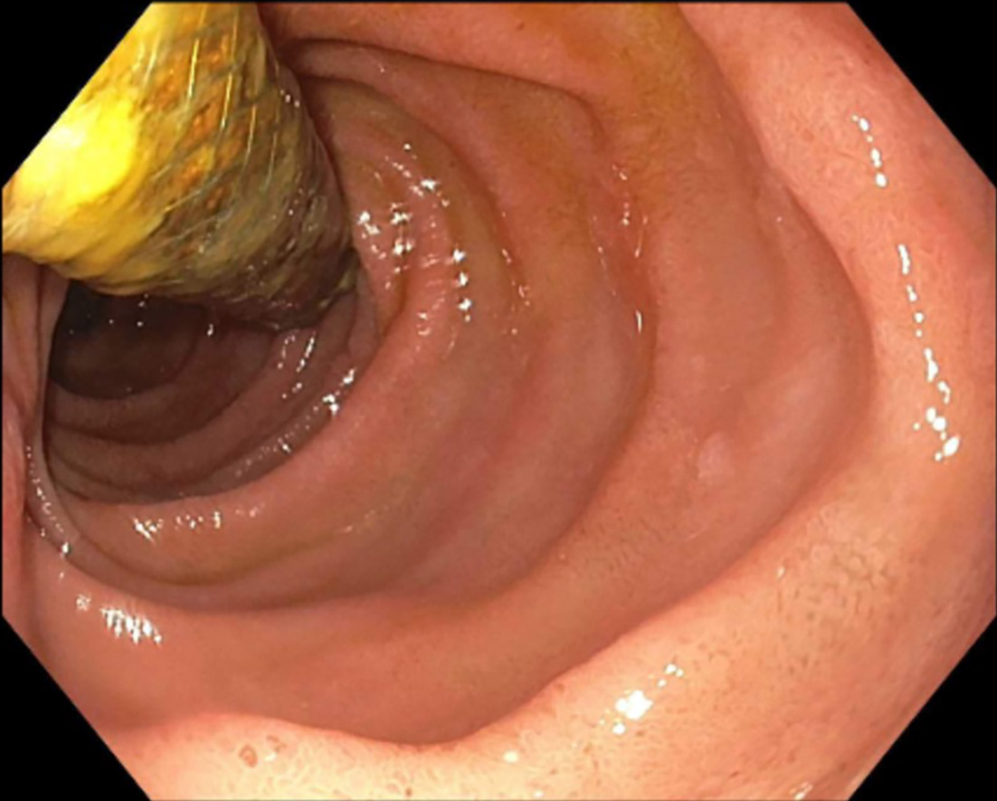 Endoscopic appearance of stent protruding from the fistulous opening proximal to the major papilla.