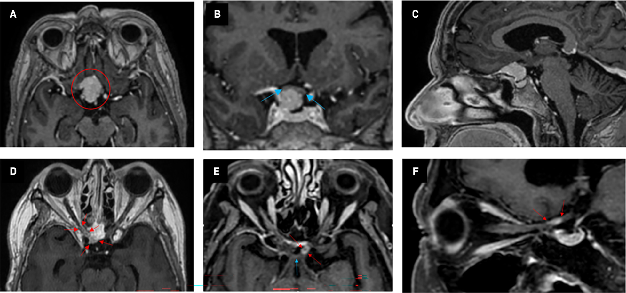 Axial T1 sequence MRIs with contrast enhancement. (A-C) MRI prior to the first tumor resection. (A) The tumor (red circle) was 18 × 22 × 15 mm in its largest dimension and was at the frontal base of the skull with a slight preponderance to the right. (B) Blue arrows indicate proximity to the chiasm. (D) MRI taken as part of radiation therapy planning. There was a sparse residual tumor (red arrows) alongside the right planum sphenoidale and in the optic canal. (E,F) MRI approximately 9 months following completion of radiation therapy. Left optic nerve contrast enhancement (red arrows) is shown in proximity to the chiasm (blue arrow).