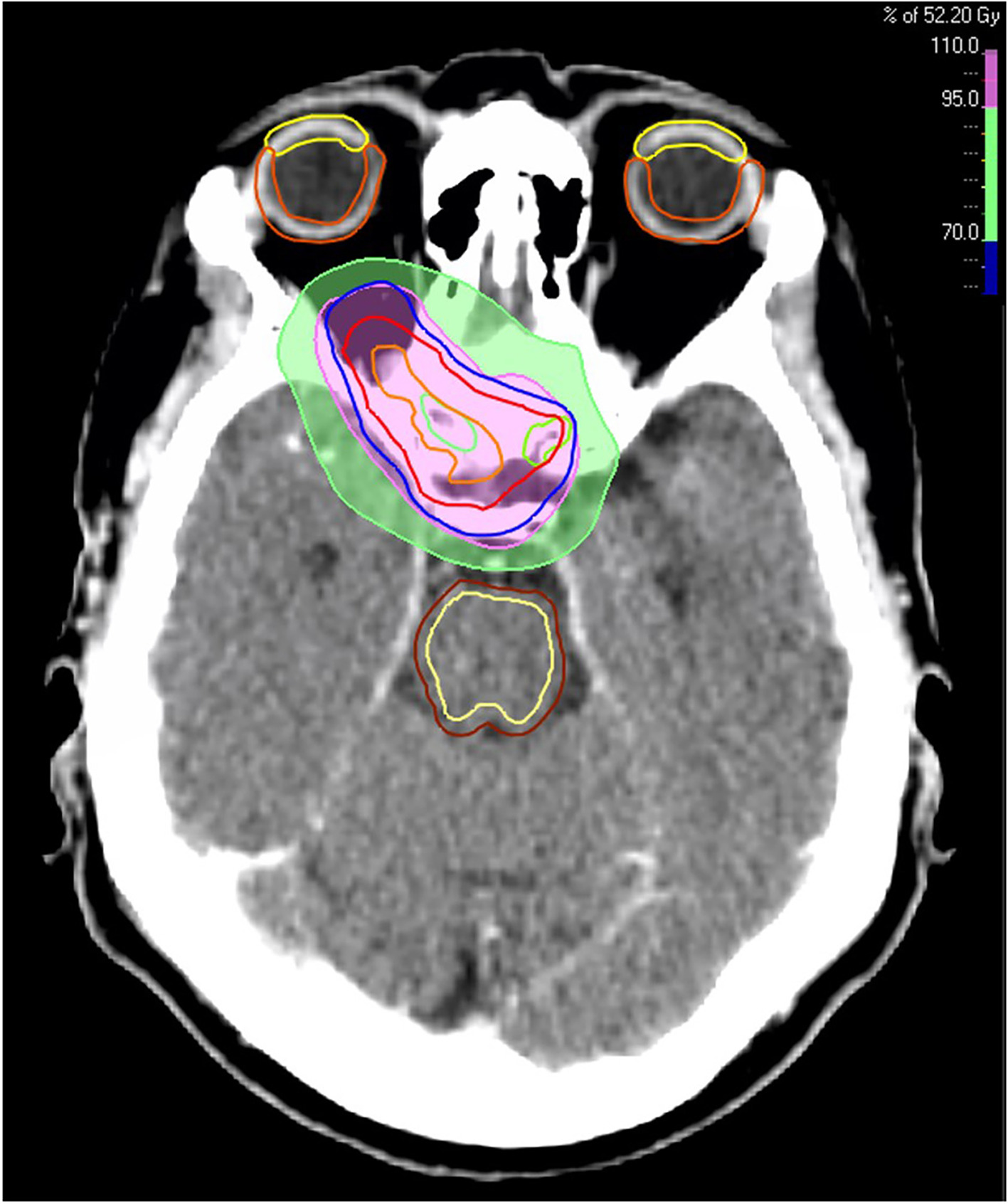 The patient’s radiation therapy plan, displaying dosage levels of 70% (green area) and 95% (pink area) of 52.2 Gy. Target volumes: orange line (gross tumor volume), red line (clinical target volume), and blue line (planning target volume). Organs at risk: green (optic nerves), yellow (cornea), orange (retina), dark brown (brainstem), and light yellow (brainstem core).