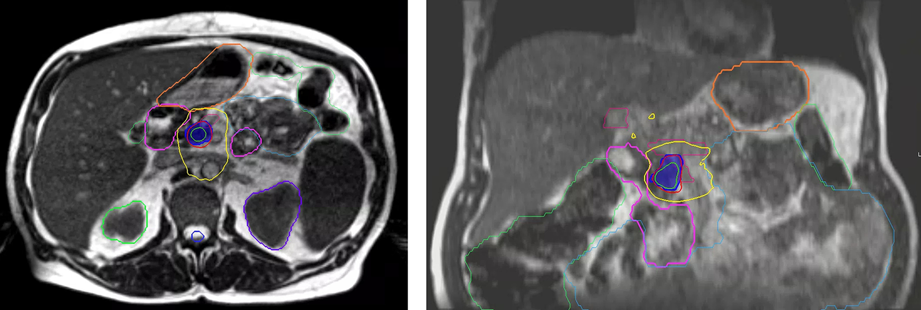 MRIdian (ViewRay) treatment plan of simultaneous modulated accelerated radiation therapy dosimetry. Dark blue color wash is the 50 Gy optimization (Opti) structure to gross disease with adaptive dose painting to target and avoid luminal organs at risk with step-and-shoot intensity-modulated radiation therapy. Adjacent portal vein/superior mesenteric vein is contoured in magenta. Other pertinent OARs for adaptive recontouring include stomach (orange), duodenum (pink), small bowel (cyan), and large bowel (green); 110%, 100%, and 60% isodose lines are displayed.