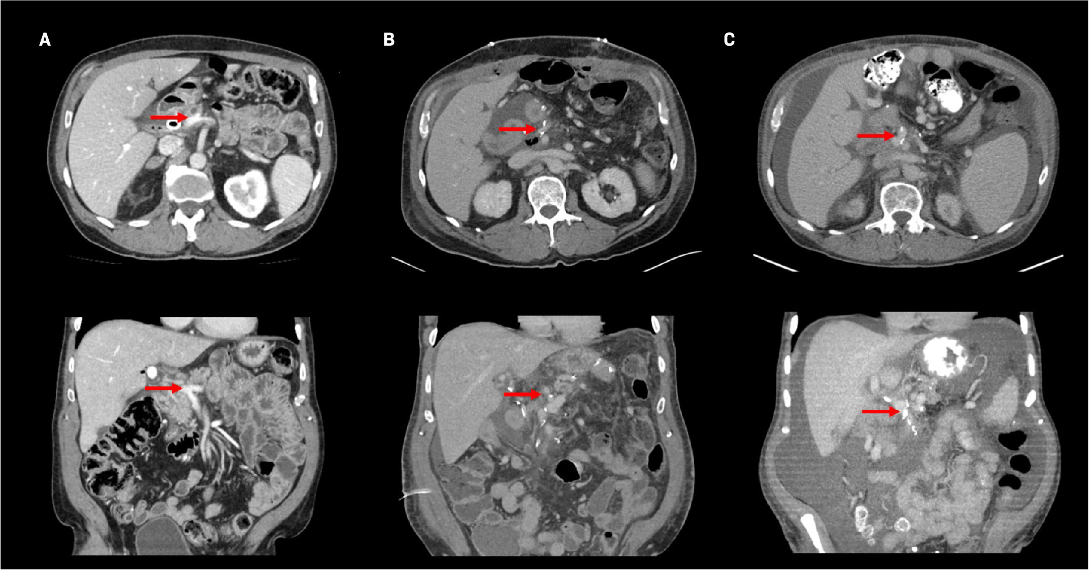 Computed tomography contrast-enhanced axial (top row) and coronal (bottom row) images of the portal vein (red arrow) following simultaneous modulated accelerated radiation therapy preoperative (A), postoperative (B), and at the development of symptomatic ascites (C).