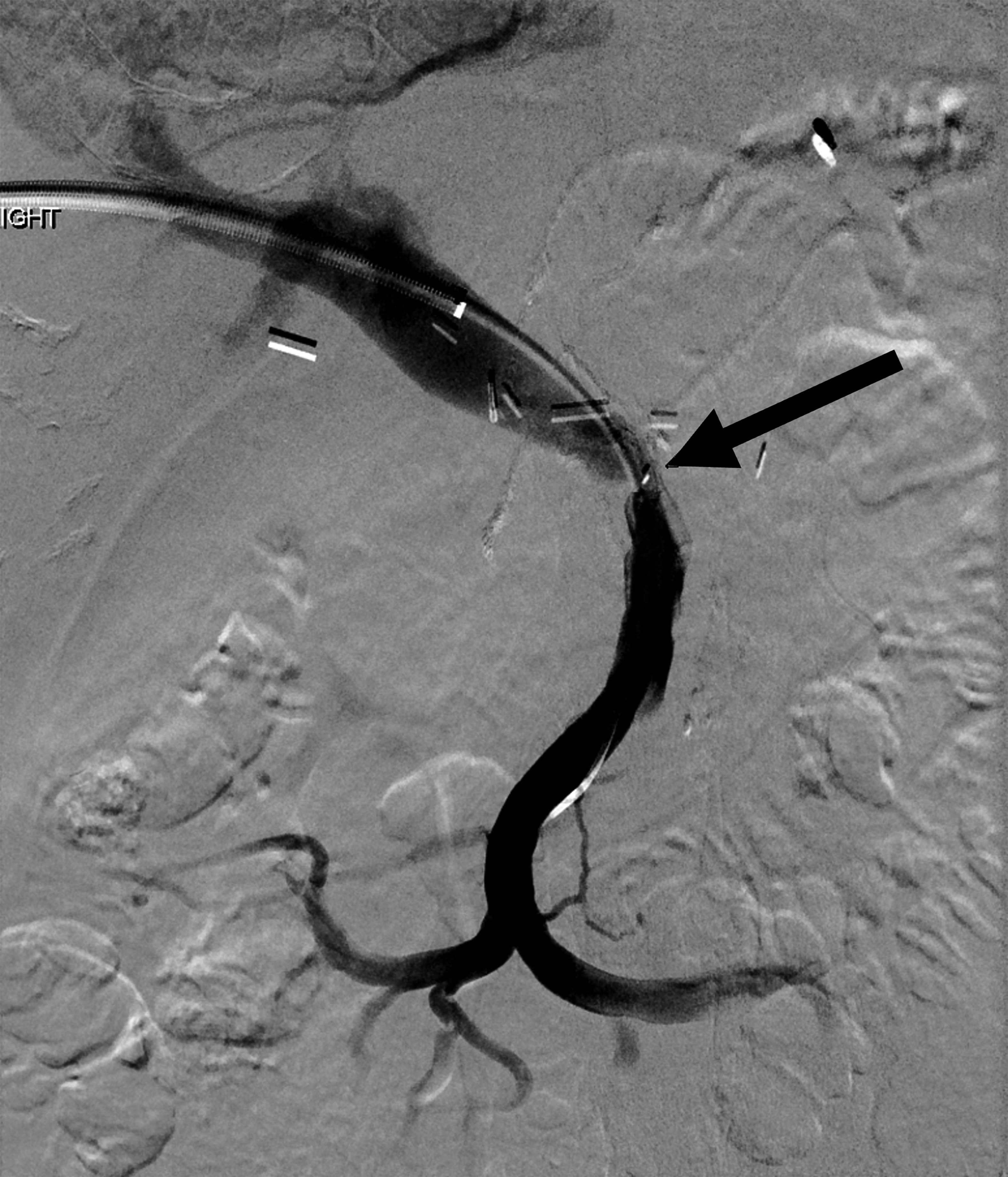 Transhepatic portal venography demonstrated stenosis of the main portal vein (PV) at the superior mesenteric vein orifice (arrow) and chronic occlusion of the splenic vein at the confluence with the main PV.
