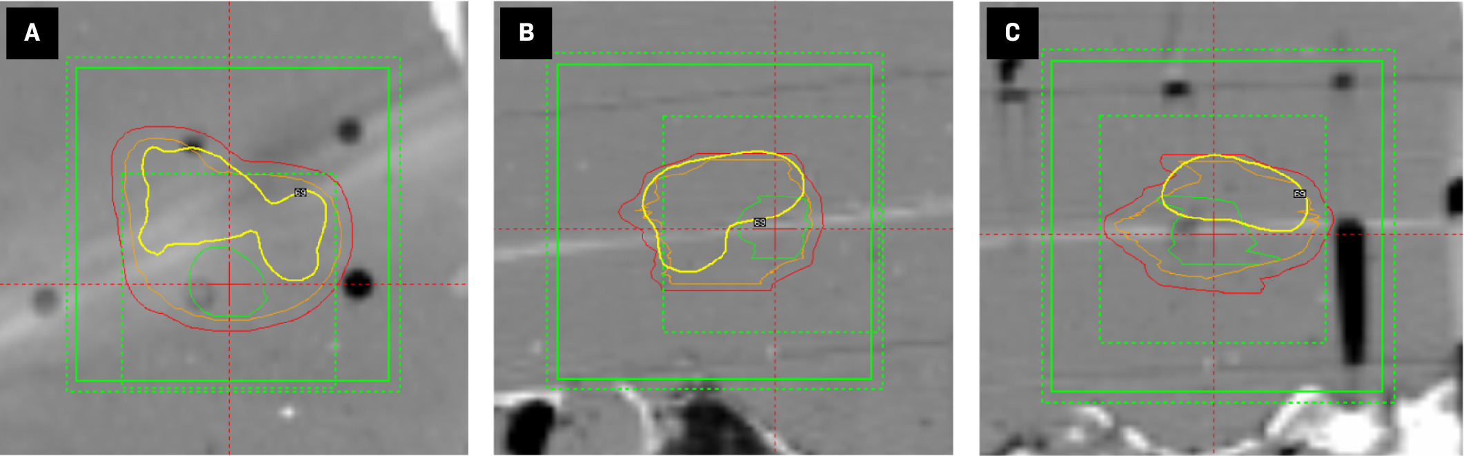 Axial (A), coronal (B), and sagittal (C) views of a simultaneous integrated boost Gamma Knife treatment plan for an anthropomorphic phantom with 3 nested target contours (red = 2-mm margin, orange = resection cavity, green = gross tumor). Three overlapping dose calculation matrices are shown by green boxes (alternating dotted and solid lines). Radiochromic film is visualized as a white streak and is localized by the red reticule. The 4 Gy isodose line (yellow contour) results from the 27 shots planned to the resection cavity target and does not represent the composite 4 Gy isodose line of the total 40-shot plan (Figure 2A).