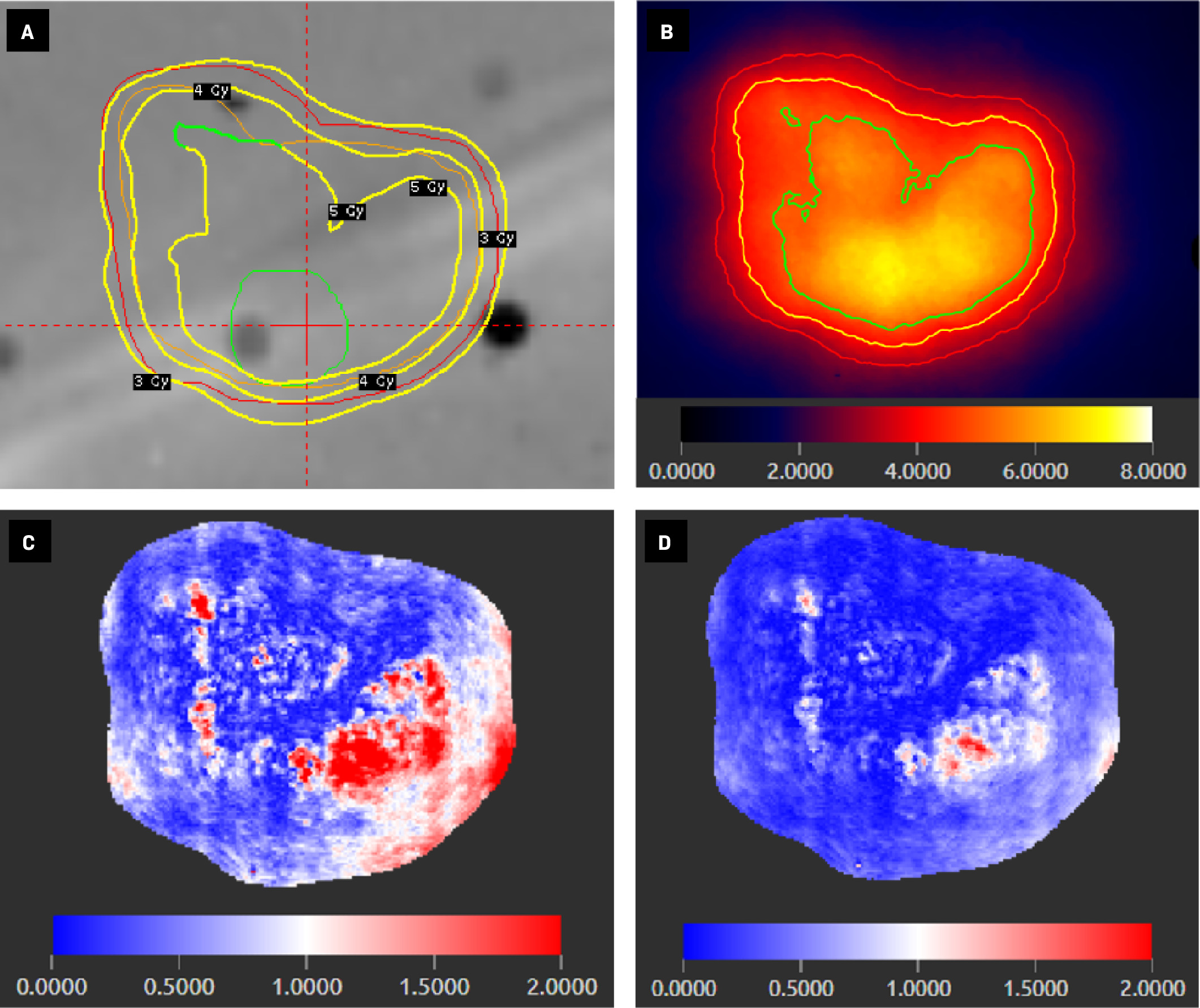 Axial view of simultaneous integrated boost Gamma Knife (Elekta) treatment plan for an anthropomorphic phantom (A) showing 3 target contours (red = 2-mm margin, orange = resection cavity, green = gross tumor) and isodose lines of 3 prescription doses (yellow contours: 3 Gy, 4 Gy, and 5 Gy). Radiochromic film of the delivered treatment plan calibrated for absolute dosimetry (B) with isodose lines of 3 prescription doses (red = 3 Gy, yellow = 4 Gy, green = 5 Gy) and color-scale legend of absolute dose (Gy). Gamma index analyses of radiochromic film at 1%/1-mm (C) and 2%/2-mm (D) tolerances with color-scale legend showing gamma index values (values <1 represent a passing score for a given point).