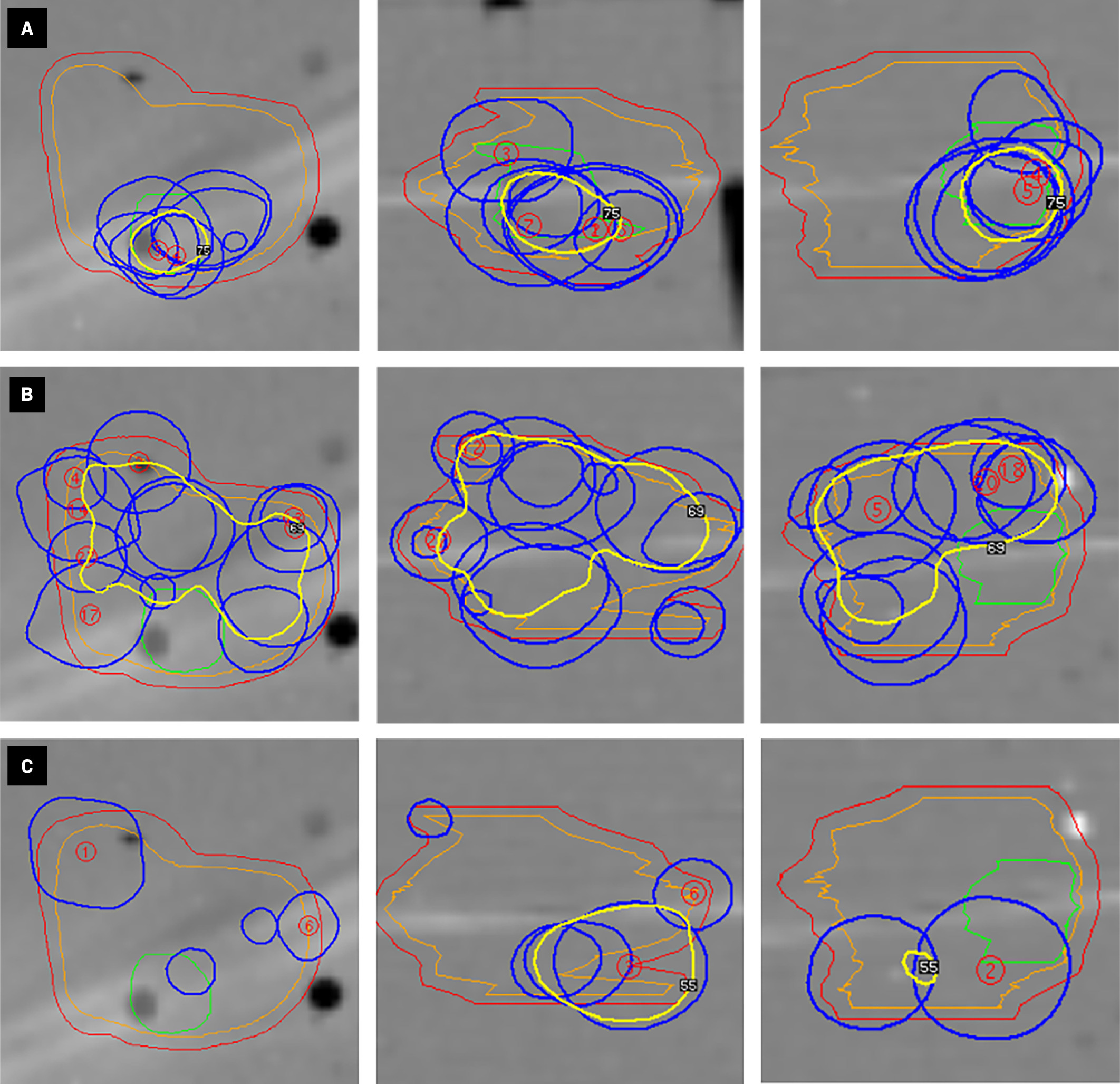 Axial, coronal, and sagittal views (arranged from left to right) of Gamma Knife (Elekta) shot position for the gross tumor (A), resection cavity (B), and 2-mm expansion (C) target volumes. The yellow contour represents the prescription isodose line for each target (2-mm expansion = 3 Gy, resection cavity = 4 Gy, gross tumor = 5 Gy) resulting from the contribution of shots planned to the given target, as opposed to the total 40-shot plan (Figure 2A).