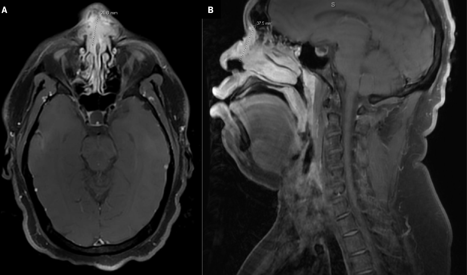 Axial (A) and sagittal (B) T1 postcontrast MRI of the face and neck demonstrates the large enhancing mass in the nasal cartilaginous septum superiorly with involvement of the nasal soft tissues bilaterally eroding the nasal bones, superior extension at the midline along the nasal bridge, and dorsal extension into the nasal cavity on the right greater than the left in close proximity to the middle and inferior turbinates and perforating the nasal septum, ventrally consistent with known squamous cell carcinoma. This measures 3.8 cm in maximum dimension.