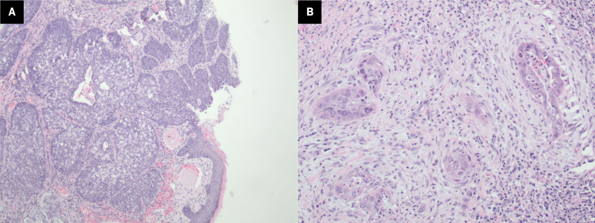 Histopathology images of the resected tumor. In situ carcinoma (A) can be seen in the overlying epithelium, with the invasive component underneath both neoplastic squamous cells and glandular cells containing intracellular mucin. Squamous and glandular infiltration (B).