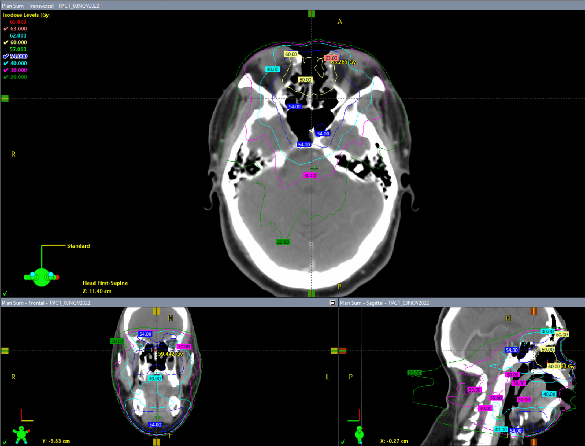 Intensity-modulated radiation therapy (IMRT) plan showing different isodose levels.