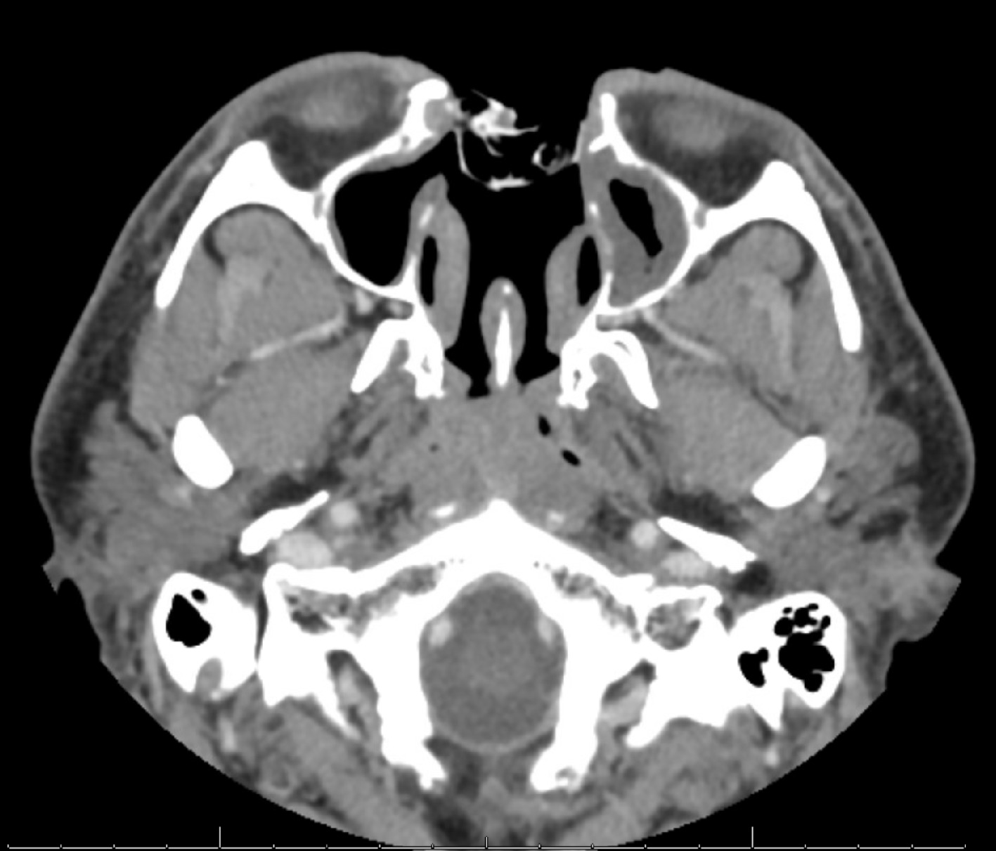 CT scan with contrast 1 year post radiation therapy. Postsurgical changes compatible with near-total rhinectomy, nasal septal resection, and middle and inferior turbinate resection are seen. Packing material is within the surgical defect. There is no new or enlarging enhancing soft tissue suggesting any recurrence.