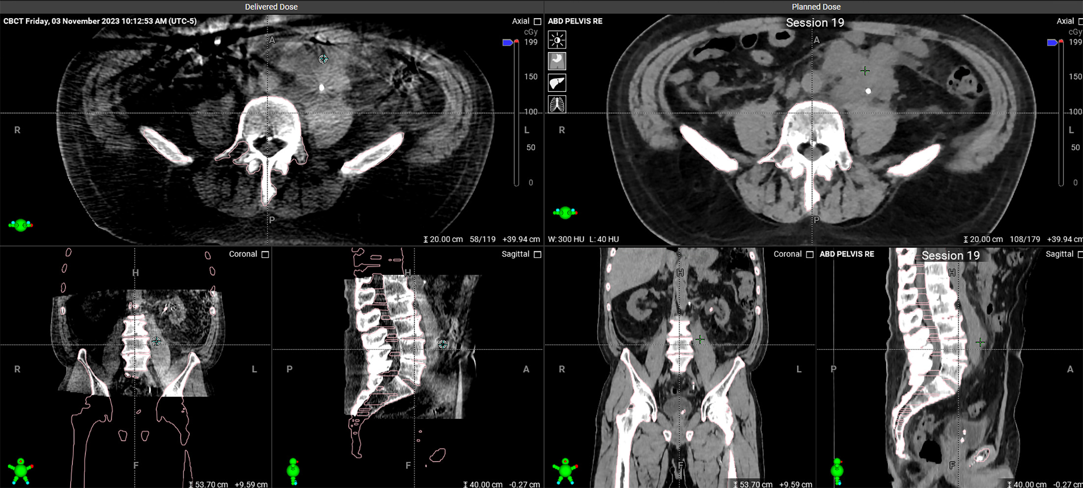 CT of the abdomen and pelvis revealing the patient’s large retroperitoneal mass