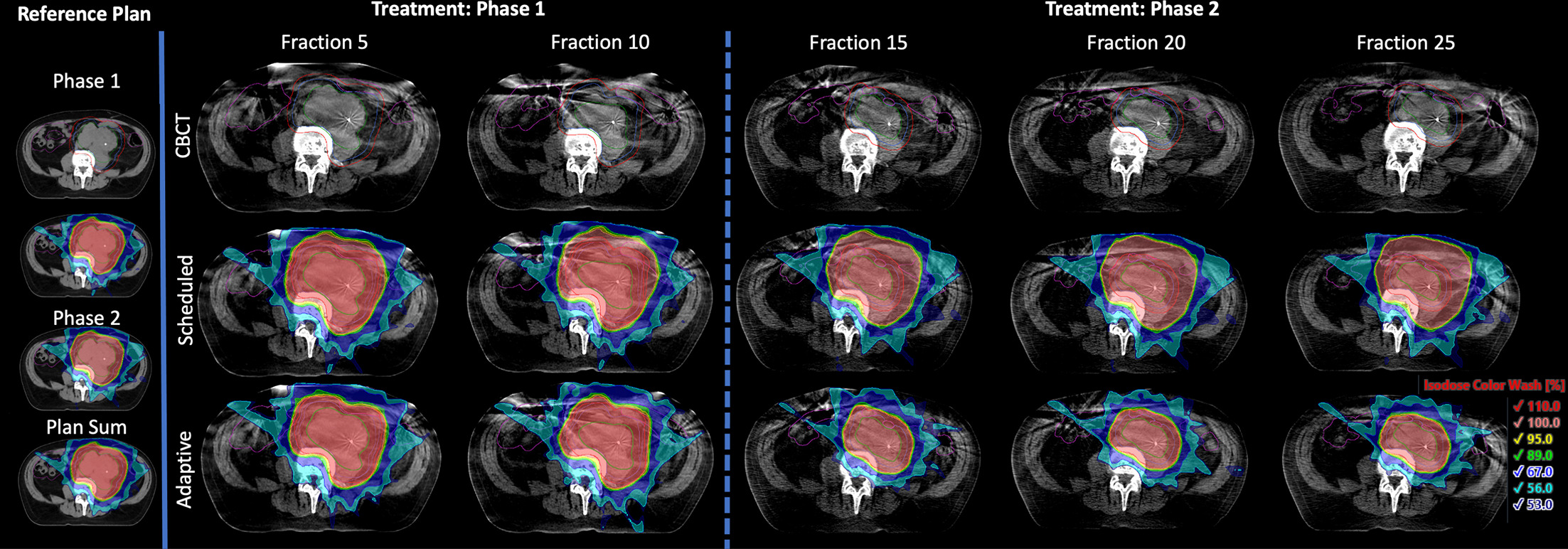 Isodose color wash from reference plans and subsequent fractions as seen on the planning CT and adaptive CBCTs, respectively. The GTVp is shown in green, CTV_High and CTV_Low in blue, PTV_High and PTV_Low in red, and bowel in purple. Starting from fraction 15, which was the first fraction for phase 2, only GTVp, CTV_High, and PTV_High are shown. Relative values for isodose color wash correspond to 49.5, 45, 42.75, 40, 30, 25.2, and 23.9 Gy when shown on the plan sum.