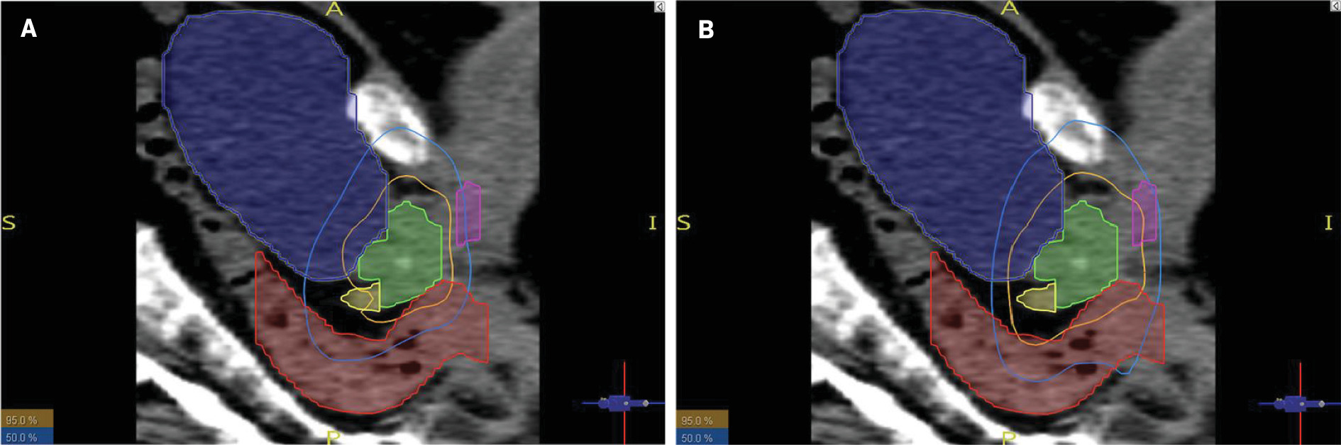 Prostate gland (green), seminal vesicles (yellow), penile bulb (pink), bladder (blue), and rectum (red) in relation to the 95% and 50% isodose lines in CHHiP (A) and PROFIT (B) plans for the same patient (patient #14)