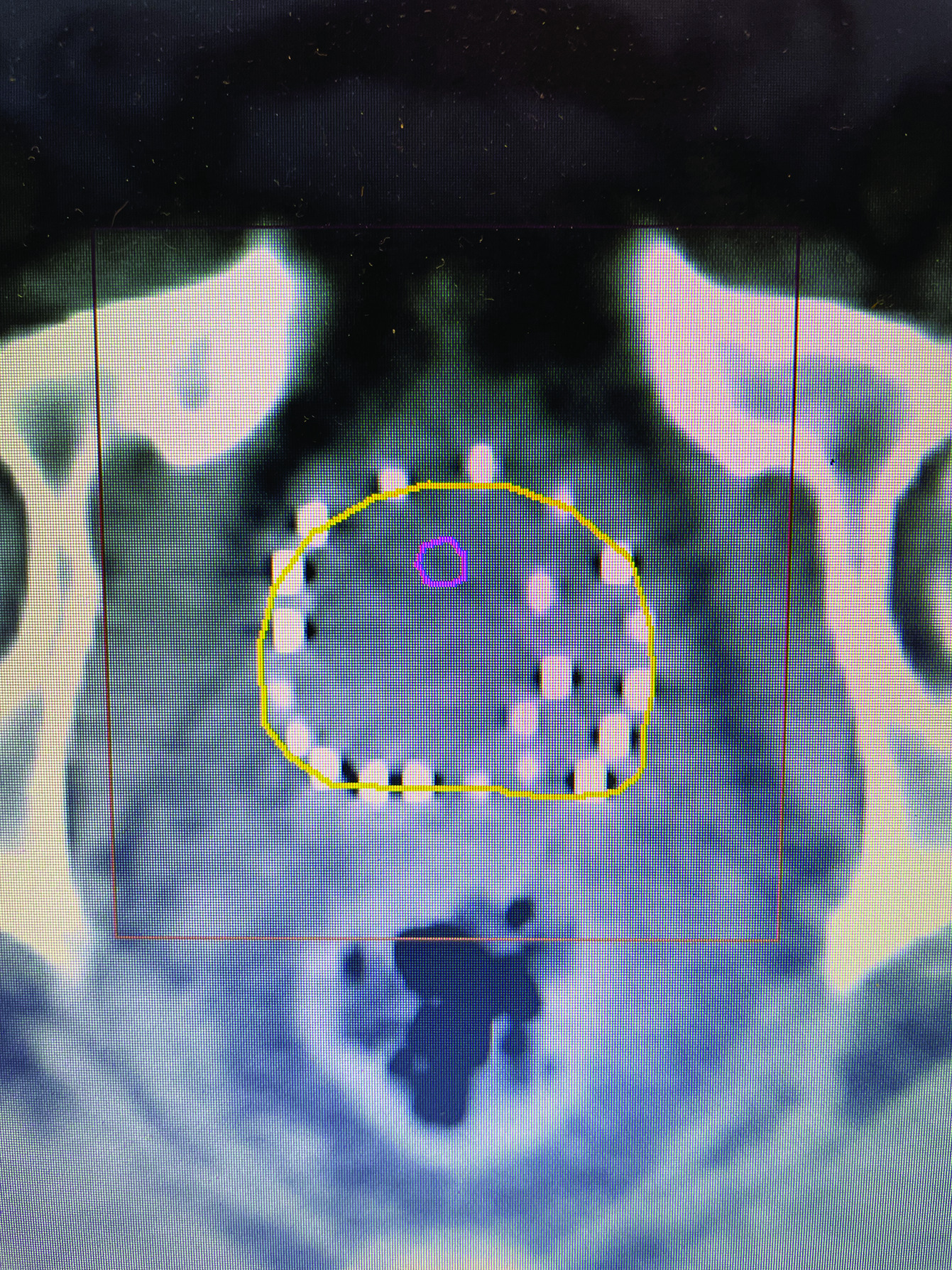 CT image of peripheral loaded seeds, with extra at left tumor location.